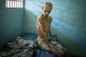 pacientes que murieron por desnutrición en Venezuela