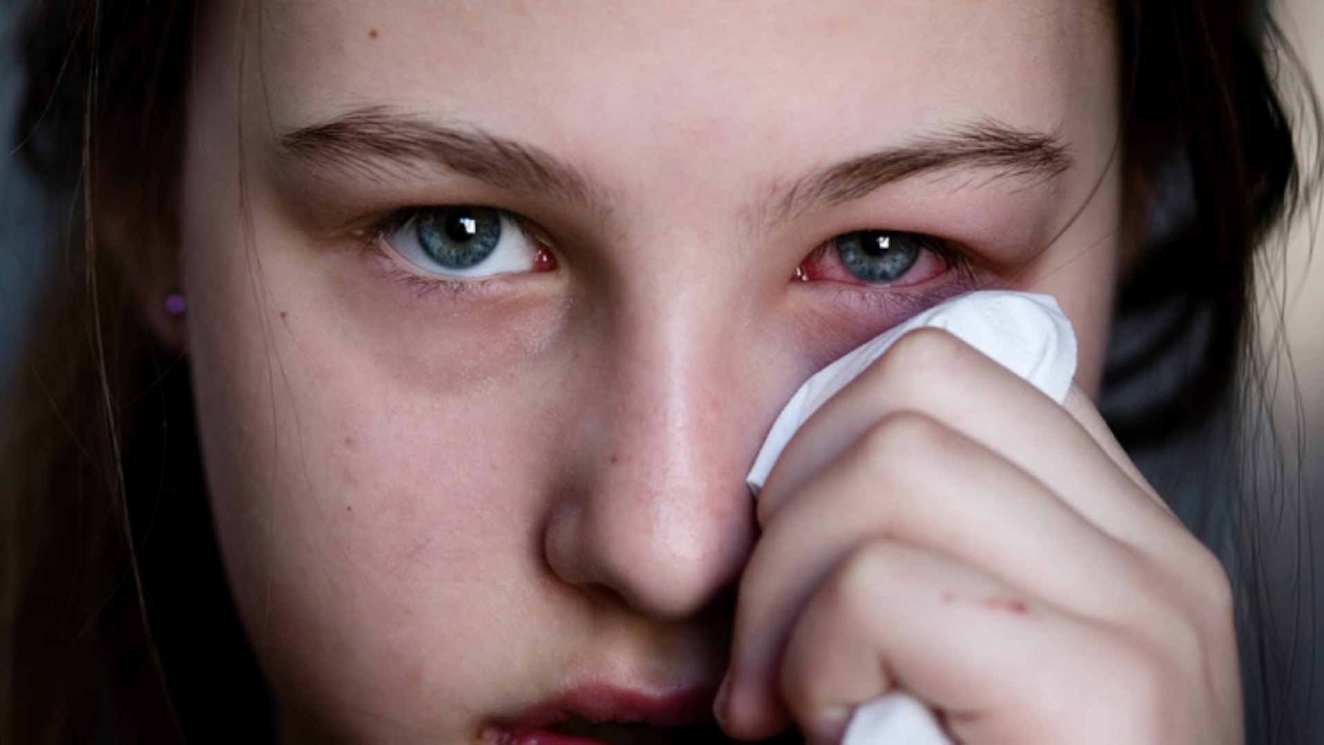 conjuntivitis