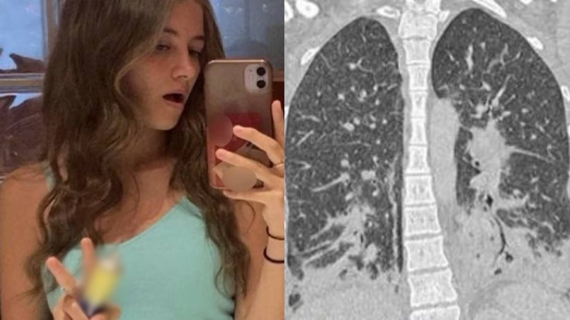 Los pulmones de una joven por utilizar el 'vape' de su novio