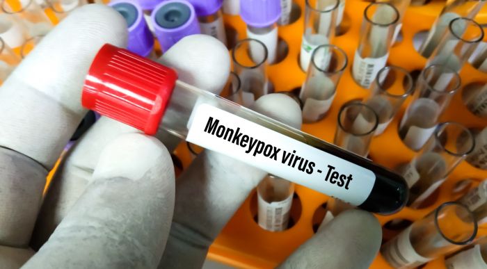 PCR viruela del mono en Lempira