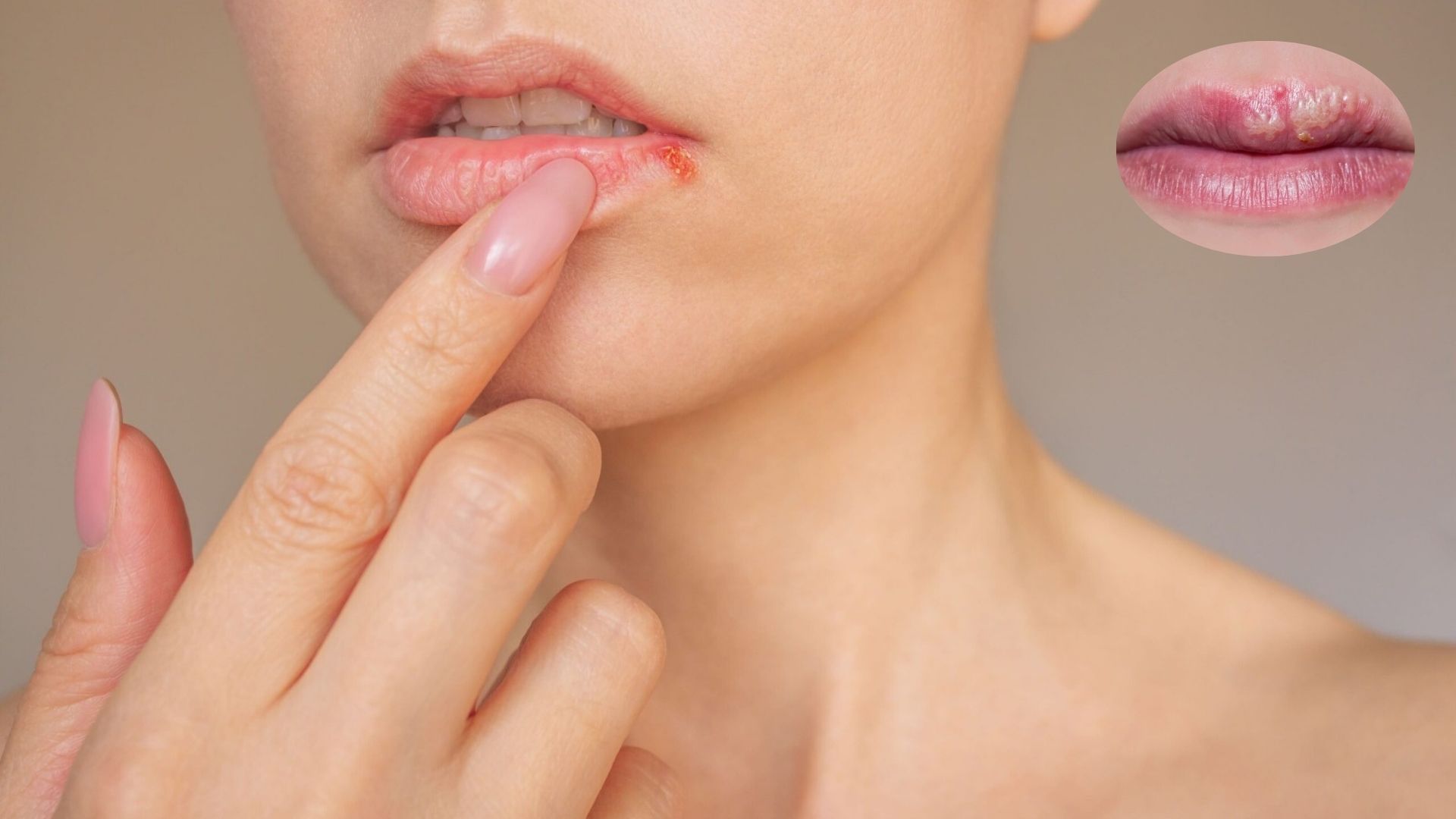 herpes labial