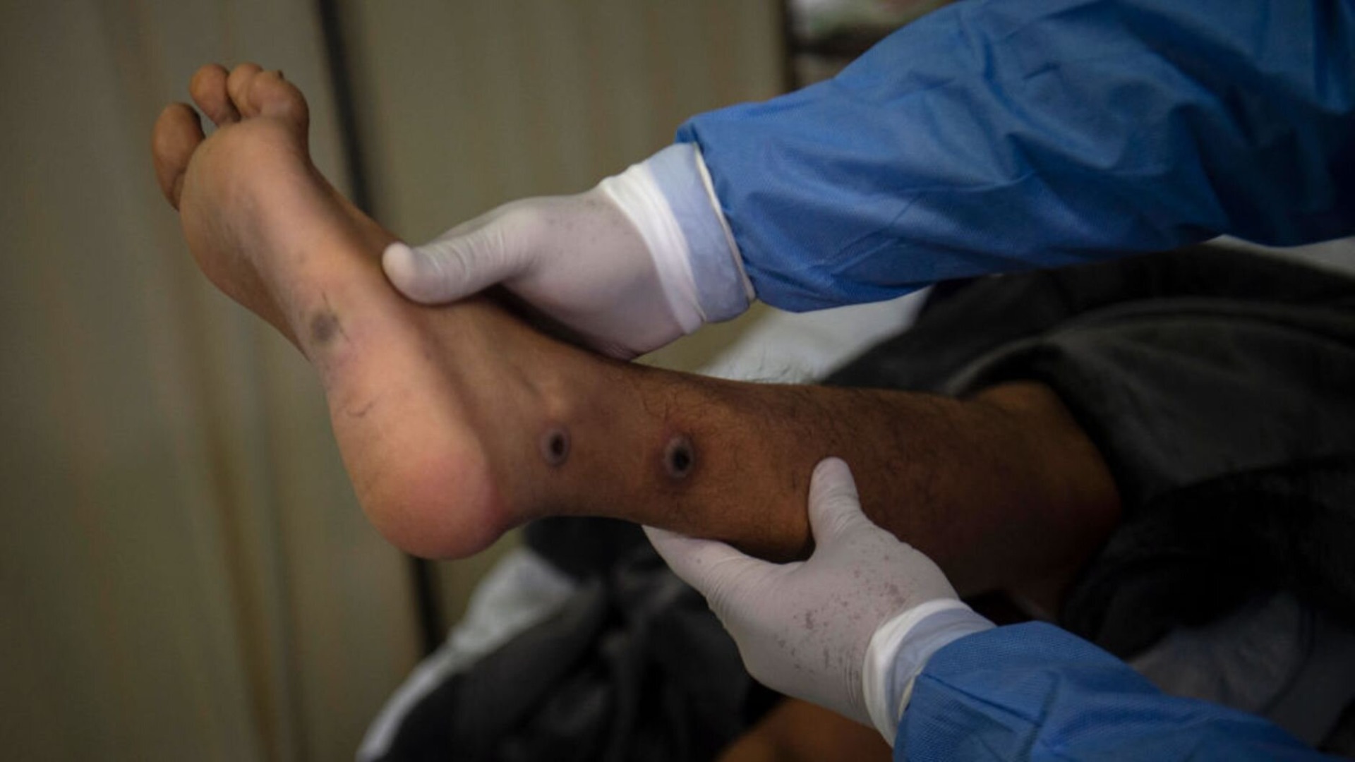 Viruela del mono Lempira Honduras casos sospechosos