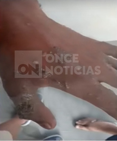 Caso sospechoso de viruela del mono en Lempira Honduras