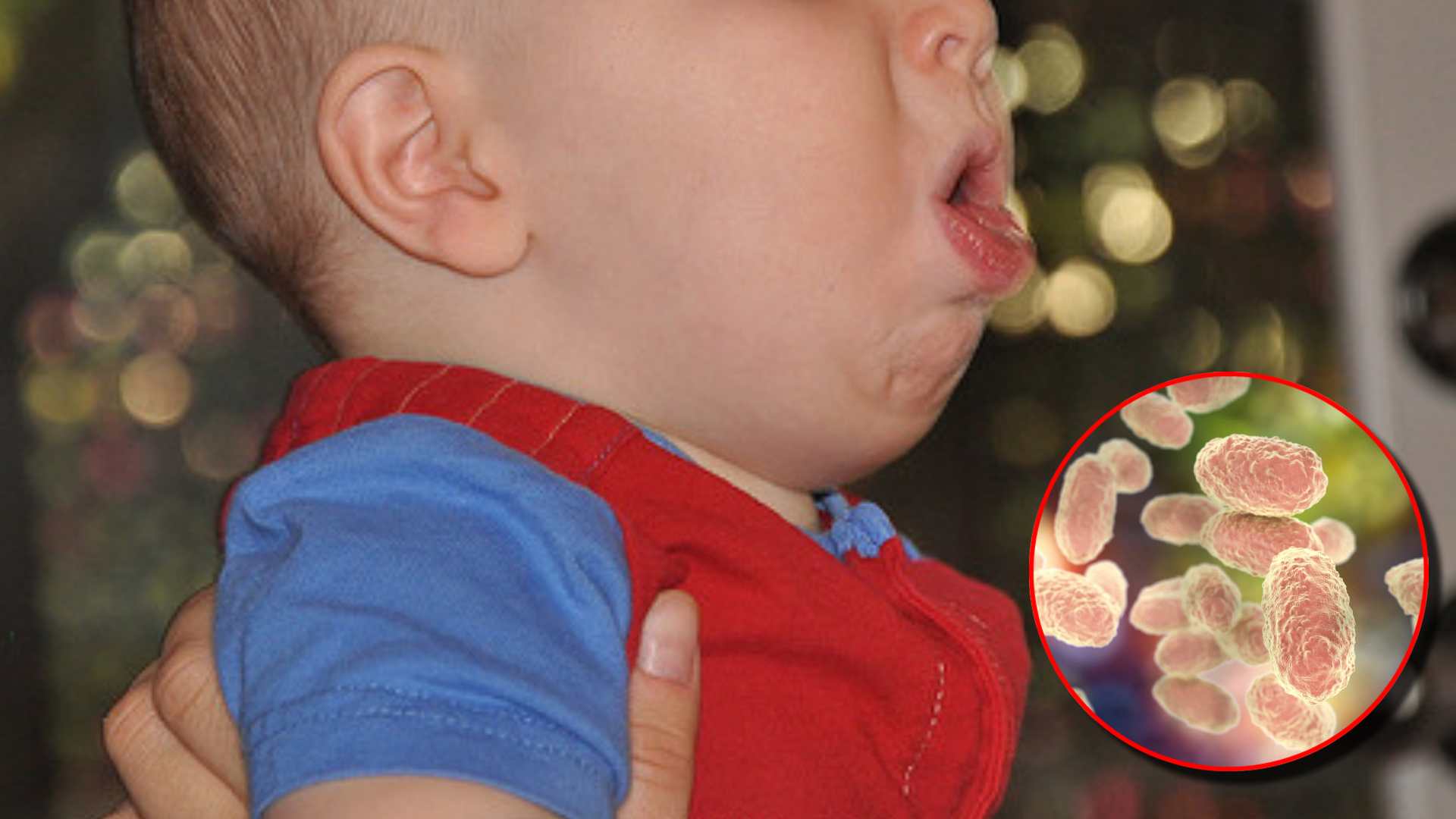 Tos ferina: ¿cómo se contagia y cuáles son sus síntomas?