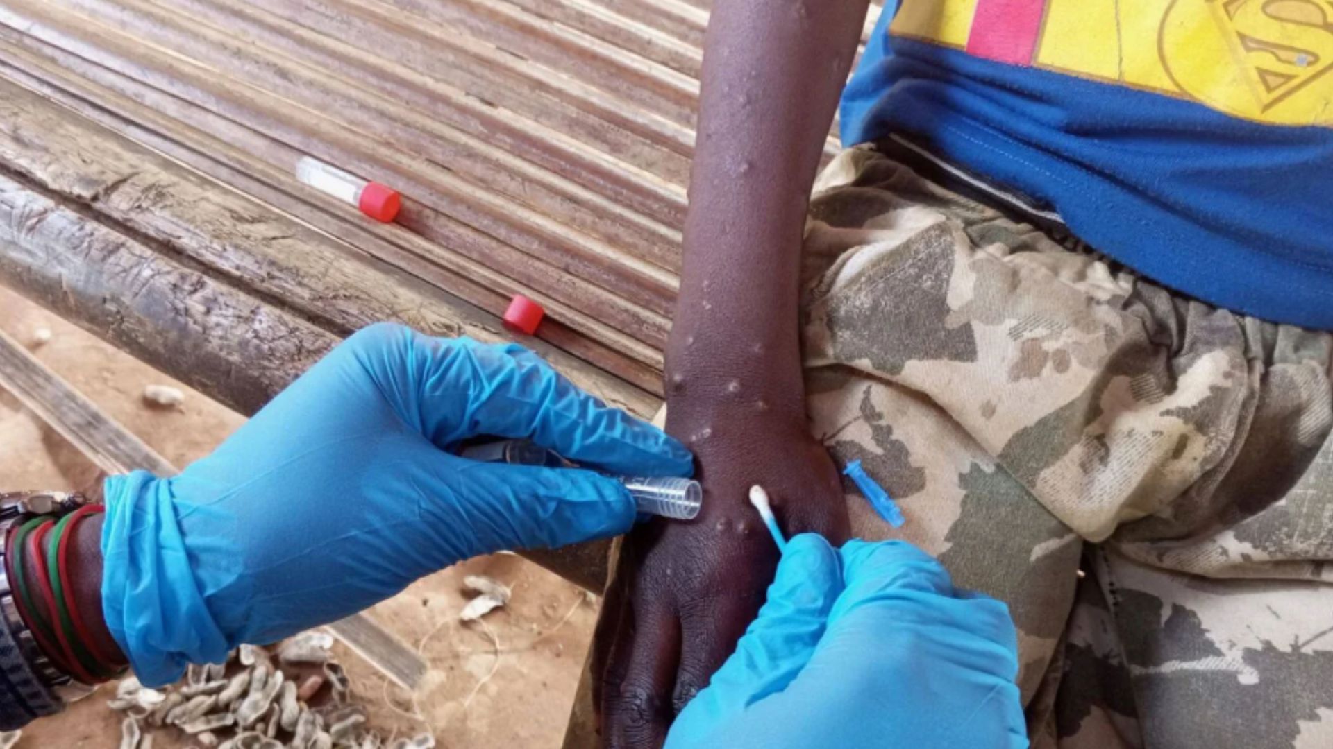 El virus de mpox puede provocar inflamación de los ganglios y erupciones cutáneas dolorosas o con picor, entre ellas granos o ampollas.