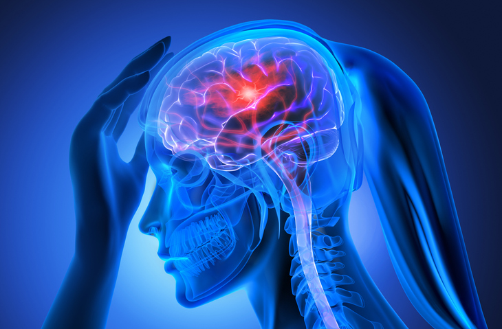 derrame cerebral