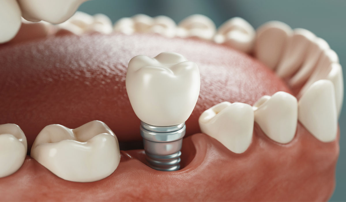 implante dental