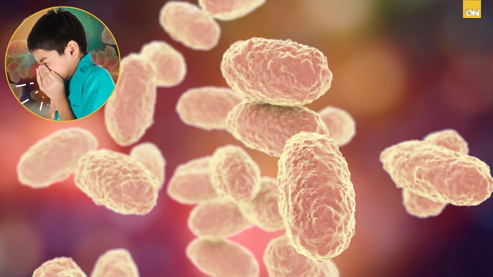 Alerta sanitaria casos de Tosferina