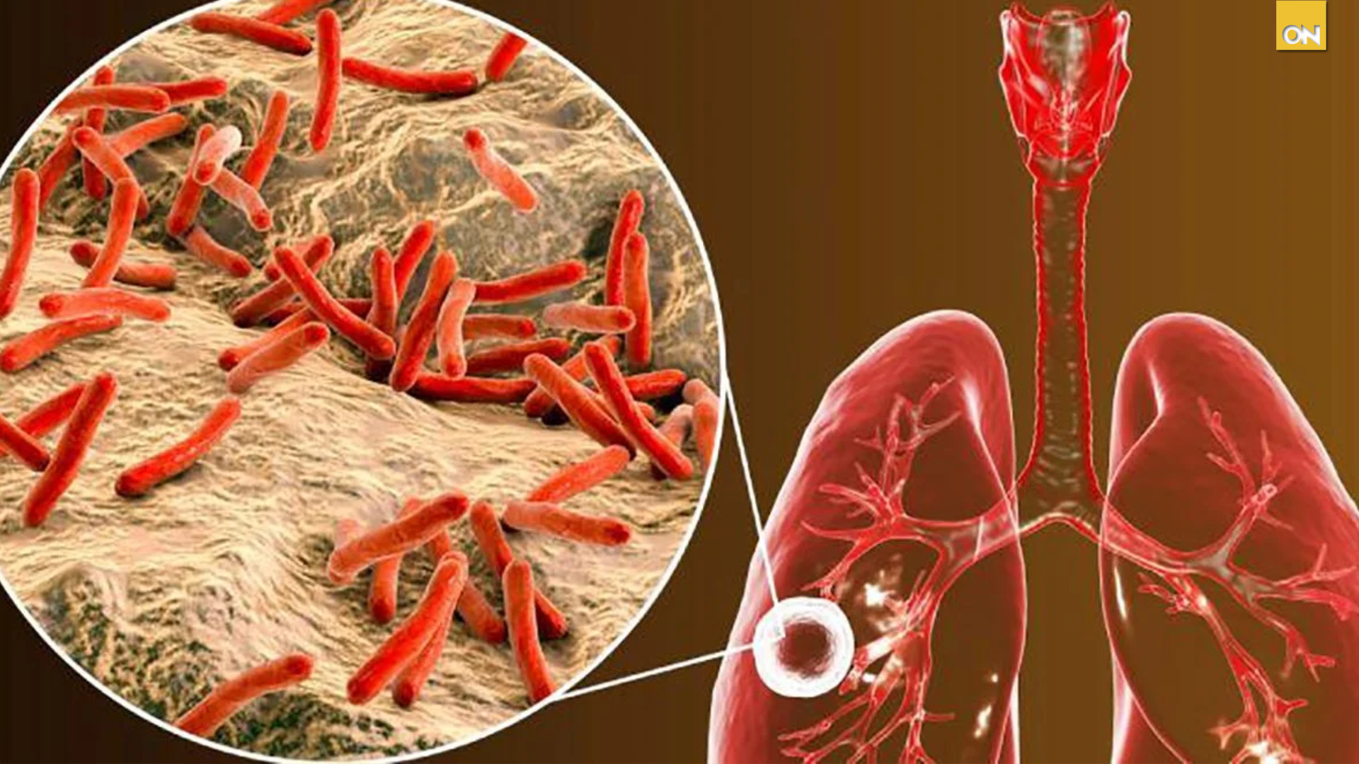Tuberculosis en Honduras