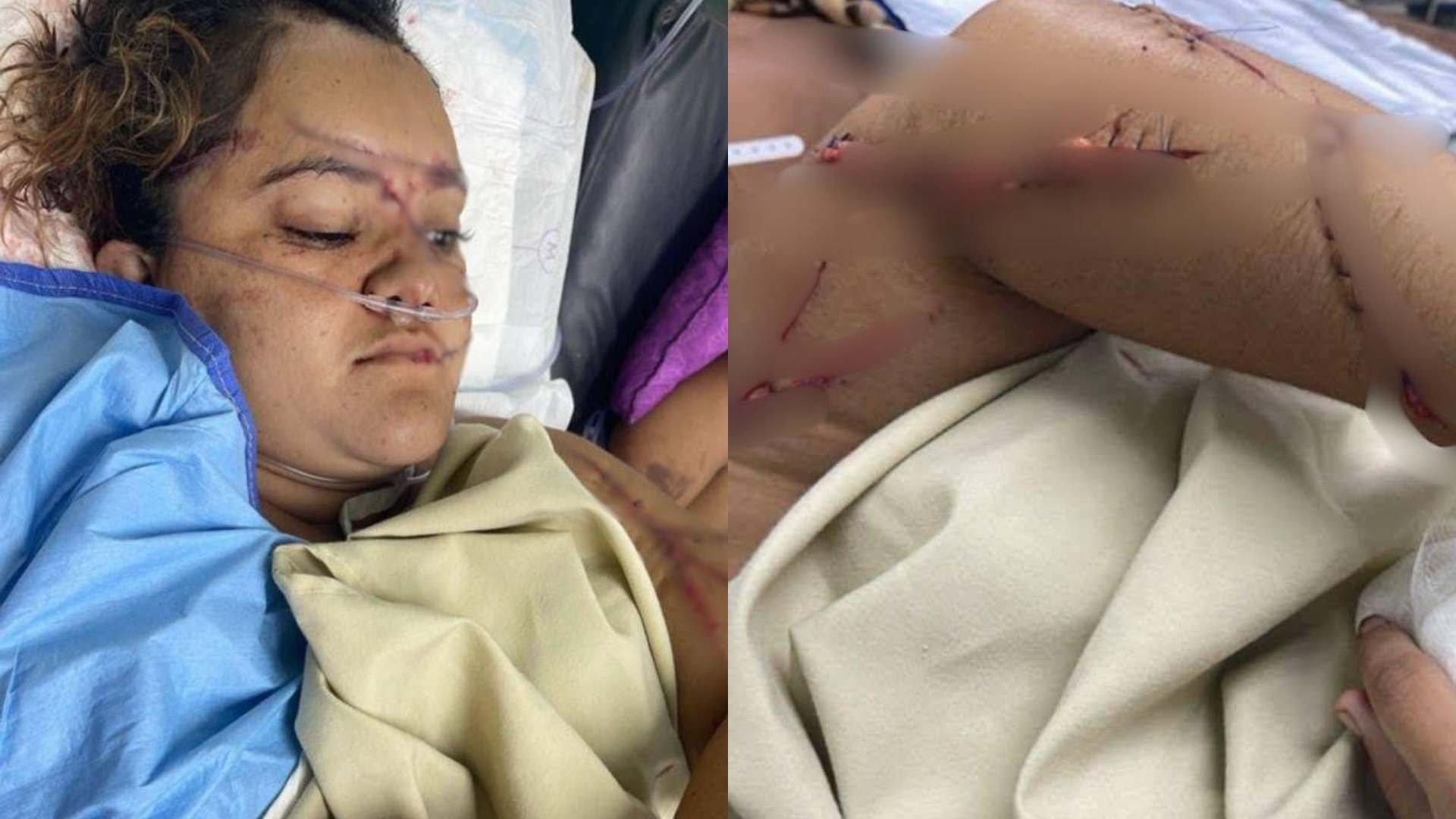 ¿Cómo está mujer atacada a machetazos en barrio Barandillas?