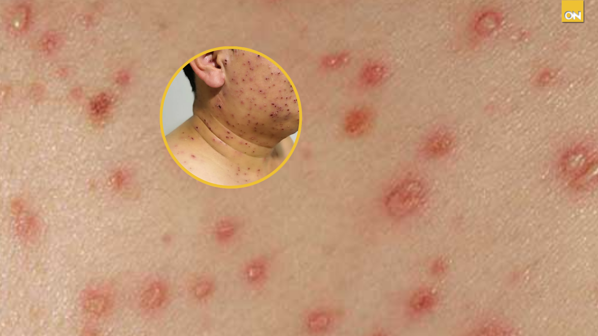 ¿Sarampión y varicela son lo mismo? Estas son sus diferencias y síntomas para protegerte