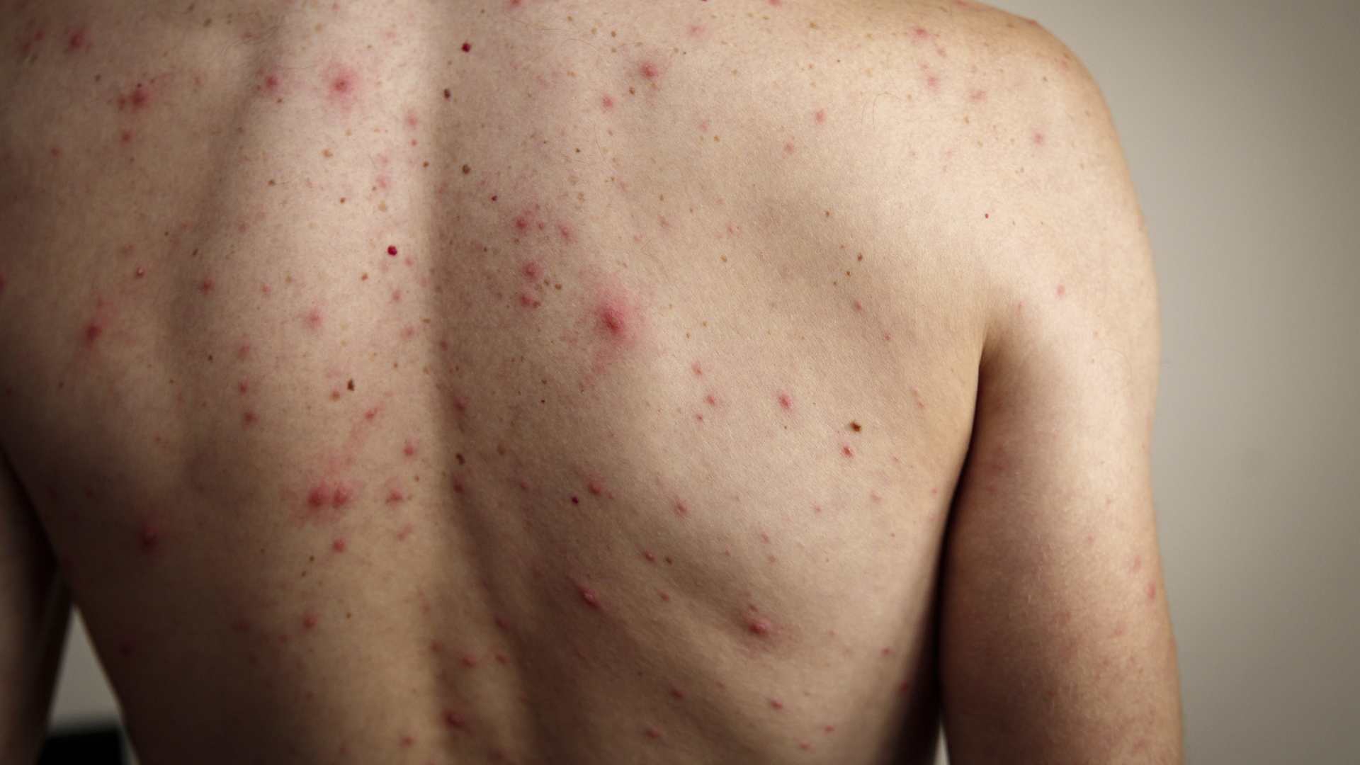 Sarampión en Honduras: ¿Qué es, cuáles son los síntomas y cómo prevenir contagio?