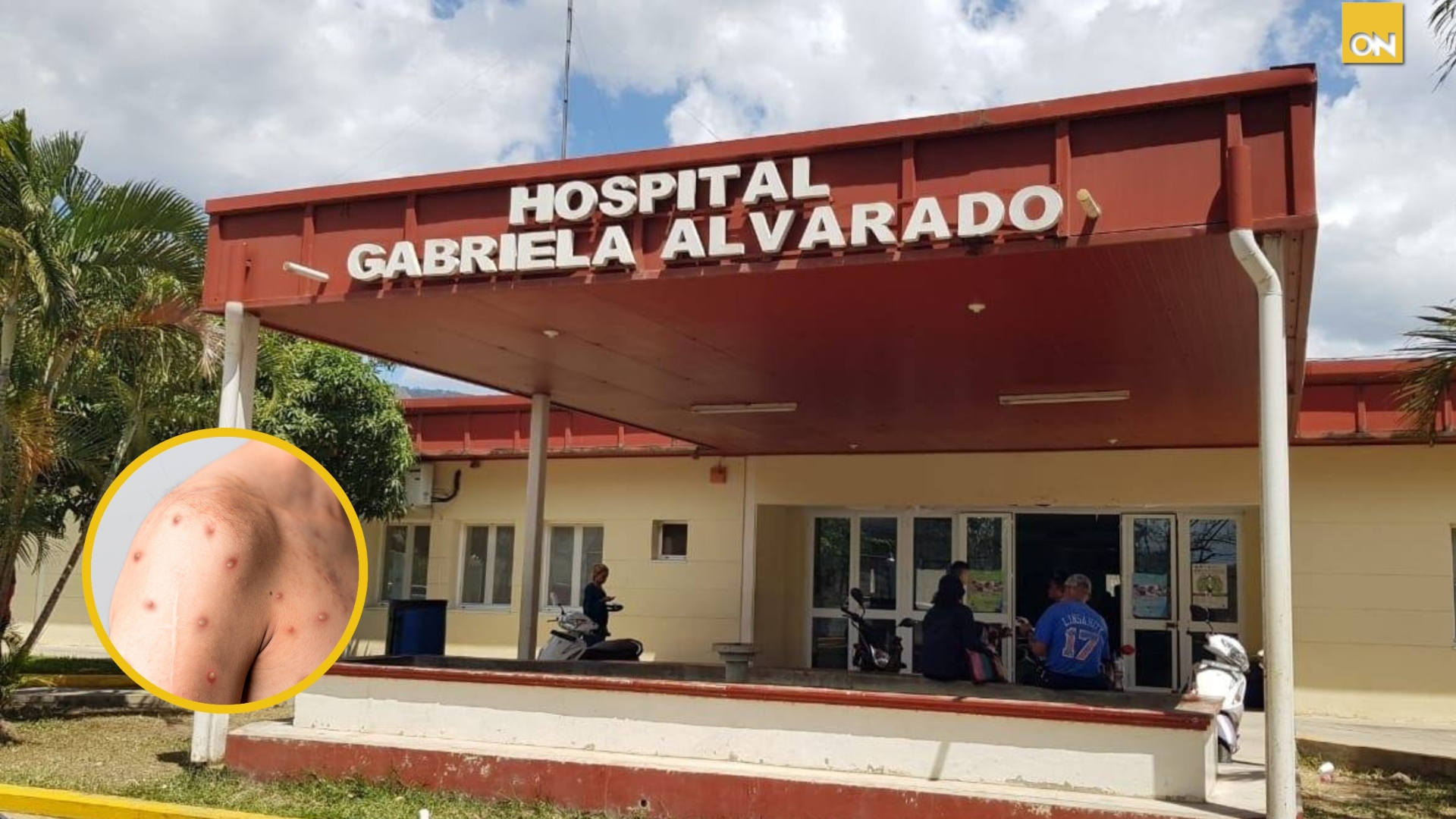 Gabriela Alvarado viruela símica