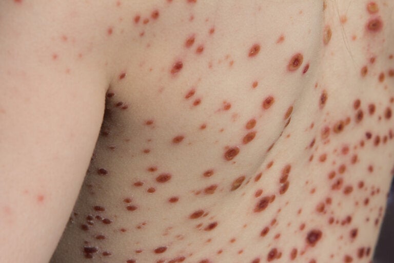 Viruela del mono o mpox: causas, síntomas, diagnóstico y tratamiento - Mejor con Salud