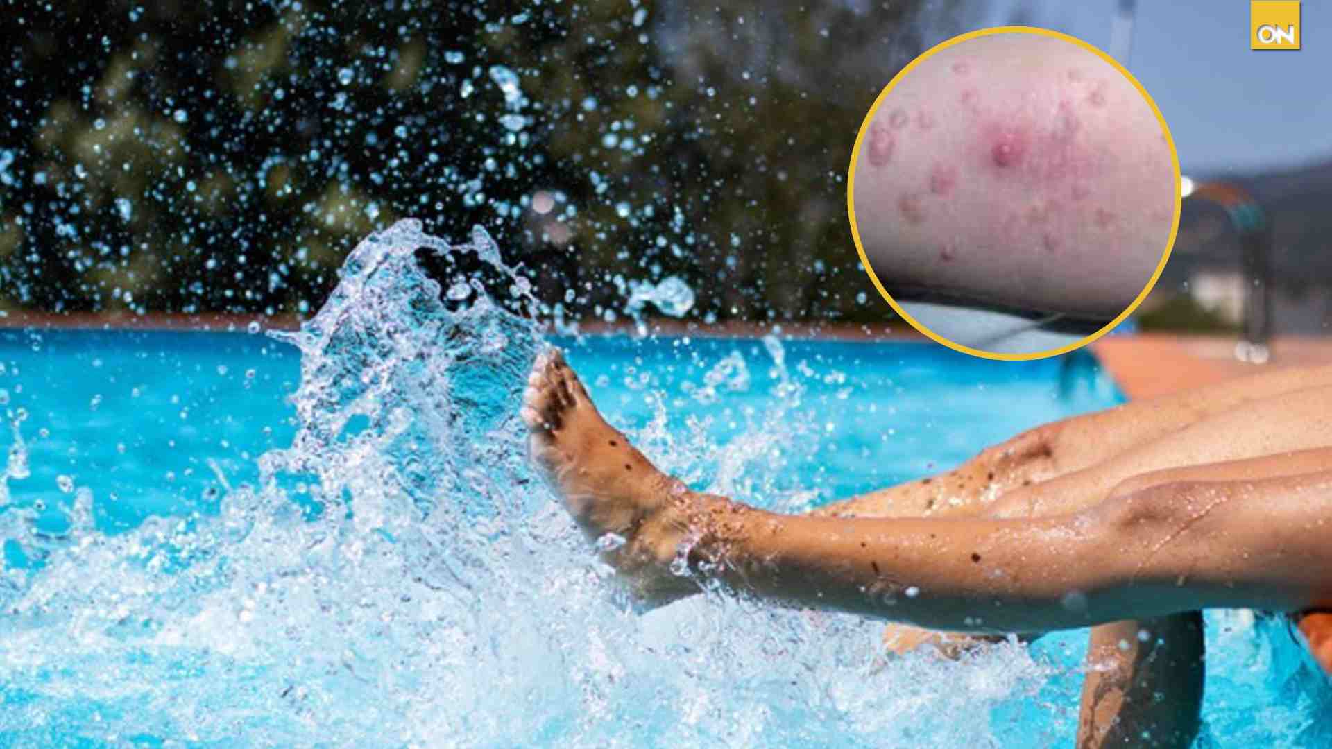 ¡Cuidado! Enfermedades que se transmiten en la piscina
