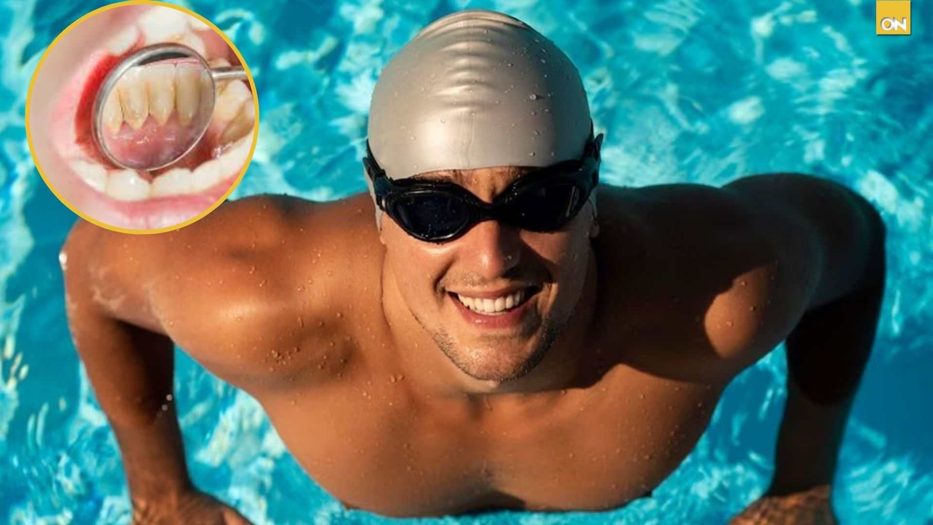 "El sarro del nadador" en los dientes, ¿qué es?