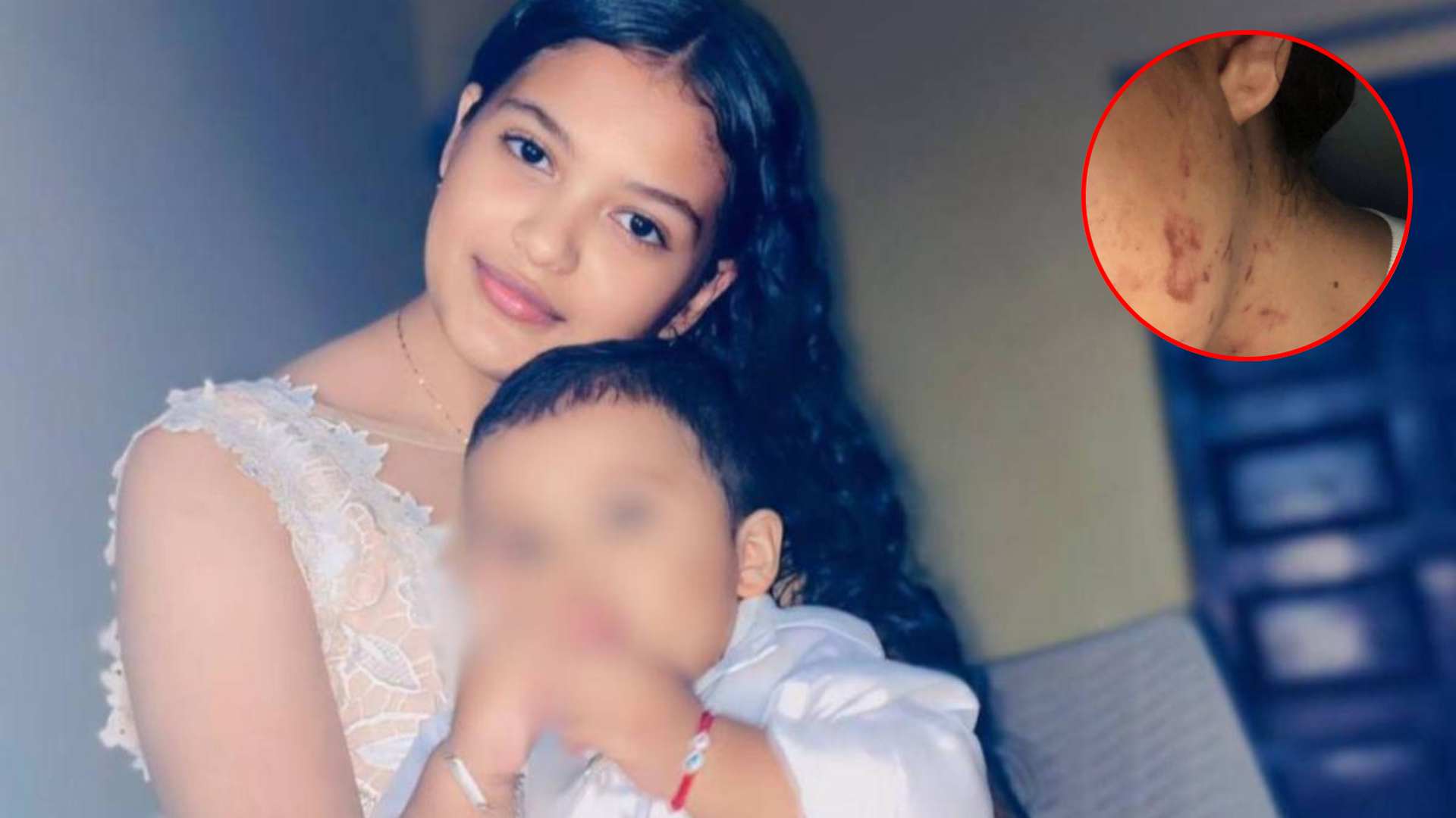Mujer atacada a mordidas por expareja en Olancho