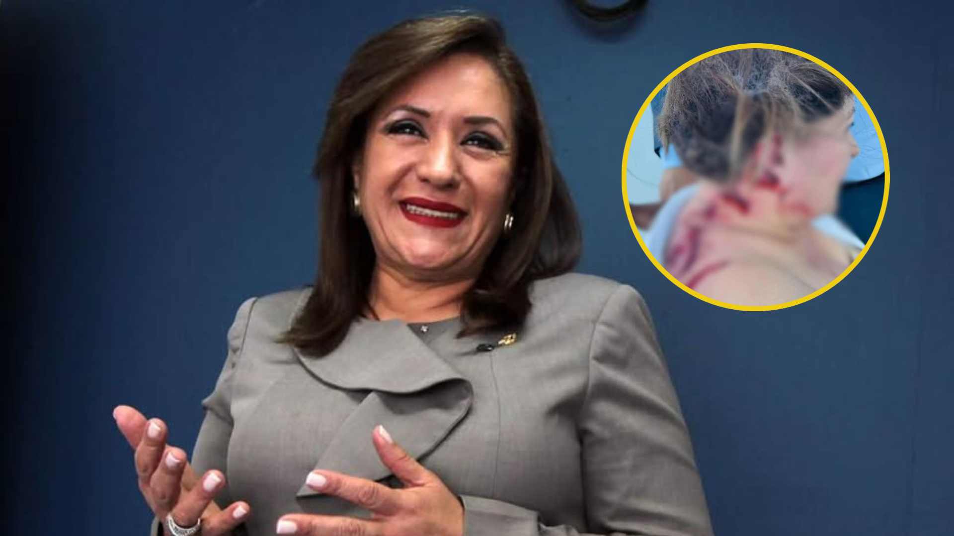 Heridas en la espalda y cabello quemado: así quedó la diputada Gladis tras ataque con explosivo
