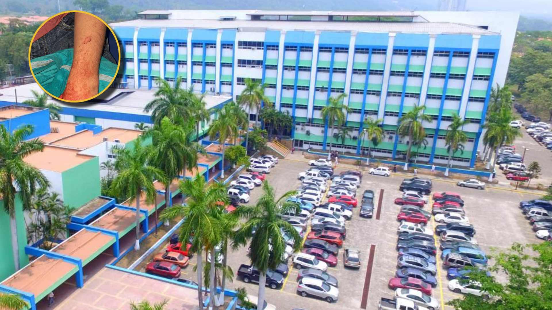 Pacientes quemados por pólvora en Hospital Catarino Rivas