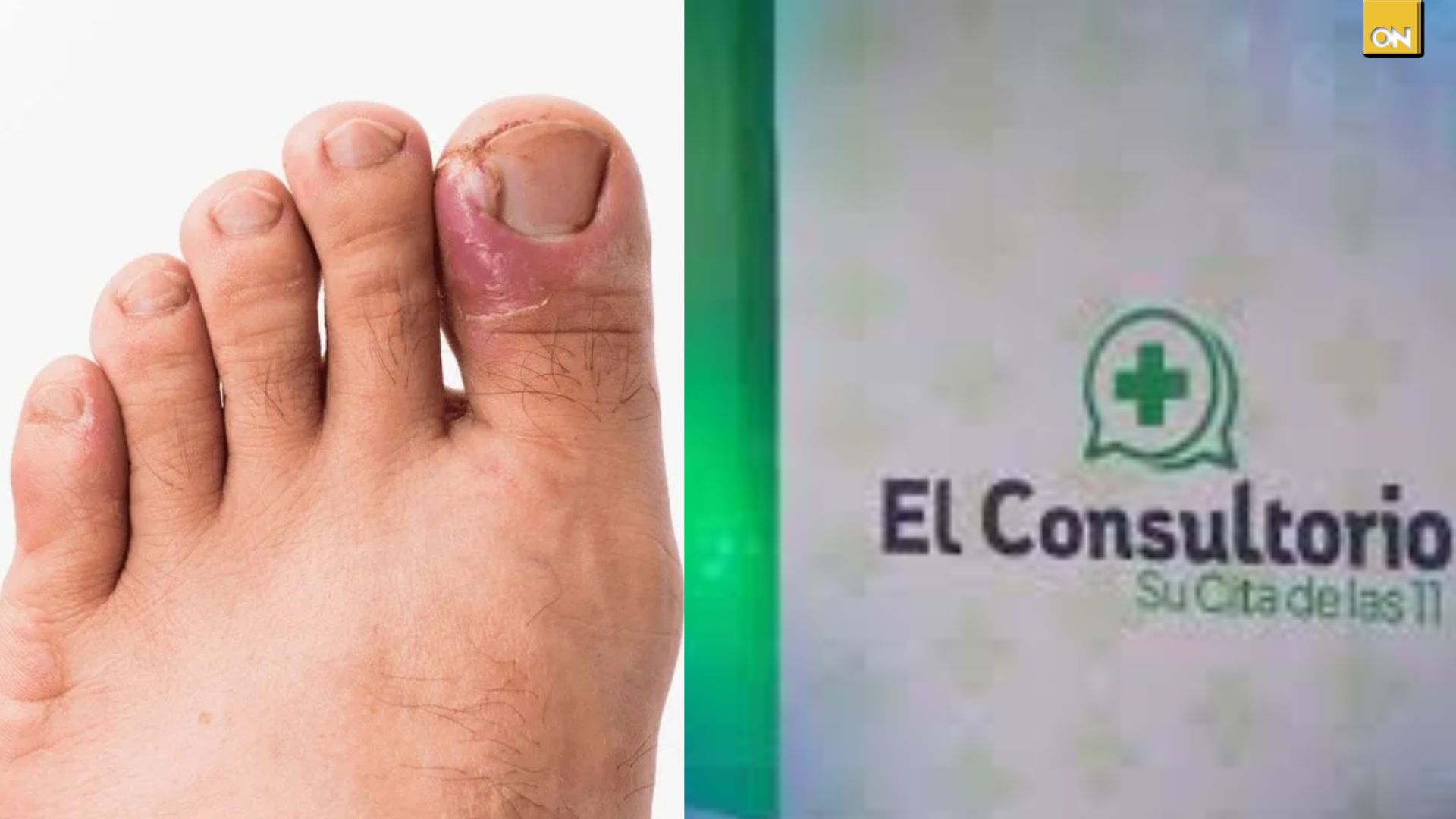Este martes 16 de febrero a las 11:00 a.m. no te pierdas el programa en El Consultorio del Once, donde estará presente la doctora Jussara Turcios Campos, experta en salud, para hablar sobre las uñas encarnadas, ya que muchas personas viven con este problema con frecuencia. De acuerdo a estudios médicos, explican que las uñas encarnadas son conocidas médicamente como onicocriptosis, que ocurren cuando el borde de la uña crece de manera anormal hacia la piel circundante, que esto provoca molestias como enrojecimiento, sensibilidad y, en casos avanzados, secreción o pus. Detallan que las principales causas que favorecen la aparición de uñas encarnadas son: • Corte incorrecto de las uñas, especialmente al redondear los bordes. • Uso de calzado demasiado ajustado. • Golpes o traumatismos repetidos en los dedos del pie. • Predisposición genética y ciertas condiciones de Salud. Algunos de los signos de alerta que deben motivar una consulta según los médicos: • Dolor al caminar o al presionar el borde de la uña. • Enrojecimiento e inflamación en el lateral del Dedo. • Sensación de calor o sensibilidad en la zona. • Aparición de tejido inflamatorio o granuloso. • En casos graves: secreción, pus o mal olor. Dan a conocer diversas opciones de tratamientos que se pueden realizar cuando se tiene este problema de unas, una de ellas el levantamiento de la uña con férulas o algodón para guiar su crecimiento, uso de antibióticos en caso de infección, corte correcto de las uñas y el uso de calzado adecuado. Detallan que algunos casos leves pueden manejarse en casa con baños de agua tibia y cuidados básicos, pero enfatizan que cuando el problema es recurrente o severo, es fundamental acudir a un podólogo o médico. Si te interesa conocer más sobre este tema, no te pierdas el programa del consultorio del once este martes 17 de febrero del 2026. La especialista Jussara, experta en el tema, estará dando más detalles sobre este padecimiento; también atenderán tus consultas a través de los números que aparecen a continuación. El Consultorio del Once, su cita de lunes a viernes, cuenta con especialistas en salud, donde las personas pueden realizar sus llamadas a los números 2262-4589 - 2262-0102 -8740-1994, expertos en salud despejarán sus consultas. Este martes 16 de febrero a las 11:00 a.m. no te pierdas el programa en El Consultorio del Once, donde estará presente la doctora Jussara Turcios Campos, experta en salud, para hablar sobre las uñas encarnadas, ya que muchas personas viven con este problema con frecuencia. De acuerdo a estudios médicos, explican que las uñas encarnadas son conocidas médicamente como onicocriptosis, que ocurren cuando el borde de la uña crece de manera anormal hacia la piel circundante, que esto provoca molestias como enrojecimiento, sensibilidad y, en casos avanzados, secreción o pus. Detallan que las principales causas que favorecen la aparición de uñas encarnadas son: • Corte incorrecto de las uñas, especialmente al redondear los bordes. • Uso de calzado demasiado ajustado. • Golpes o traumatismos repetidos en los dedos del pie. • Predisposición genética y ciertas condiciones de Salud. Algunos de los signos de alerta que deben motivar una consulta según los médicos: • Dolor al caminar o al presionar el borde de la uña. • Enrojecimiento e inflamación en el lateral del Dedo. • Sensación de calor o sensibilidad en la zona. • Aparición de tejido inflamatorio o granuloso. • En casos graves: secreción, pus o mal olor. Dan a conocer diversas opciones de tratamientos que se pueden realizar cuando se tiene este problema de unas, una de ellas el levantamiento de la uña con férulas o algodón para guiar su crecimiento, uso de antibióticos en caso de infección, corte correcto de las uñas y el uso de calzado adecuado. Detallan que algunos casos leves pueden manejarse en casa con baños de agua tibia y cuidados básicos, pero enfatizan que cuando el problema es recurrente o severo, es fundamental acudir a un podólogo o médico. Si te interesa conocer más sobre este tema, no te pierdas el programa del consultorio del once este martes 17 de febrero del 2026. La especialista Jussara, experta en el tema, estará dando más detalles sobre este padecimiento; también atenderán tus consultas a través de los números que aparecen a continuación. El Consultorio del Once, su cita de lunes a viernes, cuenta con especialistas en salud, donde las personas pueden realizar sus llamadas a los números 2262-4589 - 2262-0102 -8740-1994, expertos en salud despejarán sus consultas. Este martes 16 de febrero a las 11:00 a.m. no te pierdas el programa en El Consultorio del Once, donde estará presente la doctora Jussara Turcios Campos, experta en salud, para hablar sobre las uñas encarnadas, ya que muchas personas viven con este problema con frecuencia. De acuerdo a estudios médicos, explican que las uñas encarnadas son conocidas médicamente como onicocriptosis, que ocurren cuando el borde de la uña crece de manera anormal hacia la piel circundante, que esto provoca molestias como enrojecimiento, sensibilidad y, en casos avanzados, secreción o pus. Detallan que las principales causas que favorecen la aparición de uñas encarnadas son: • Corte incorrecto de las uñas, especialmente al redondear los bordes. • Uso de calzado demasiado ajustado. • Golpes o traumatismos repetidos en los dedos del pie. • Predisposición genética y ciertas condiciones de Salud. Algunos de los signos de alerta que deben motivar una consulta según los médicos: • Dolor al caminar o al presionar el borde de la uña. • Enrojecimiento e inflamación en el lateral del Dedo. • Sensación de calor o sensibilidad en la zona. • Aparición de tejido inflamatorio o granuloso. • En casos graves: secreción, pus o mal olor. Dan a conocer diversas opciones de tratamientos que se pueden realizar cuando se tiene este problema de unas, una de ellas el levantamiento de la uña con férulas o algodón para guiar su crecimiento, uso de antibióticos en caso de infección, corte correcto de las uñas y el uso de calzado adecuado. Detallan que algunos casos leves pueden manejarse en casa con baños de agua tibia y cuidados básicos, pero enfatizan que cuando el problema es recurrente o severo, es fundamental acudir a un podólogo o médico. Si te interesa conocer más sobre este tema, no te pierdas el programa del consultorio del once este martes 17 de febrero del 2026. La especialista Jussara, experta en el tema, estará dando más detalles sobre este padecimiento; también atenderán tus consultas a través de los números que aparecen a continuación. El Consultorio del Once, su cita de lunes a viernes, cuenta con especialistas en salud, donde las personas pueden realizar sus llamadas a los números 2262-4589 - 2262-0102 -8740-1994, expertos en salud despejarán sus consultas. Este martes 16 de febrero a las 11:00 a.m. no te pierdas el programa en El Consultorio del Once, donde estará presente la doctora Jussara Turcios Campos, experta en salud, para hablar sobre las uñas encarnadas, ya que muchas personas viven con este problema con frecuencia. De acuerdo a estudios médicos, explican que las uñas encarnadas son conocidas médicamente como onicocriptosis, que ocurren cuando el borde de la uña crece de manera anormal hacia la piel circundante, que esto provoca molestias como enrojecimiento, sensibilidad y, en casos avanzados, secreción o pus. Detallan que las principales causas que favorecen la aparición de uñas encarnadas son: • Corte incorrecto de las uñas, especialmente al redondear los bordes. • Uso de calzado demasiado ajustado. • Golpes o traumatismos repetidos en los dedos del pie. • Predisposición genética y ciertas condiciones de Salud. Algunos de los signos de alerta que deben motivar una consulta según los médicos: • Dolor al caminar o al presionar el borde de la uña. • Enrojecimiento e inflamación en el lateral del Dedo. • Sensación de calor o sensibilidad en la zona. • Aparición de tejido inflamatorio o granuloso. • En casos graves: secreción, pus o mal olor. Dan a conocer diversas opciones de tratamientos que se pueden realizar cuando se tiene este problema de unas, una de ellas el levantamiento de la uña con férulas o algodón para guiar su crecimiento, uso de antibióticos en caso de infección, corte correcto de las uñas y el uso de calzado adecuado. Detallan que algunos casos leves pueden manejarse en casa con baños de agua tibia y cuidados básicos, pero enfatizan que cuando el problema es recurrente o severo, es fundamental acudir a un podólogo o médico. Si te interesa conocer más sobre este tema, no te pierdas el programa del consultorio del once este martes 17 de febrero del 2026. La especialista Jussara, experta en el tema, estará dando más detalles sobre este padecimiento; también atenderán tus consultas a través de los números que aparecen a continuación. El Consultorio del Once, su cita de lunes a viernes, cuenta con especialistas en salud, donde las personas pueden realizar sus llamadas a los números 2262-4589 - 2262-0102 -8740-1994, expertos en salud despejarán sus consultas. Este martes 16 de febrero a las 11:00 a.m. no te pierdas el programa en El Consultorio del Once, donde estará presente la doctora Jussara Turcios Campos, experta en salud, para hablar sobre las uñas encarnadas, ya que muchas personas viven con este problema con frecuencia. De acuerdo a estudios médicos, explican que las uñas encarnadas son conocidas médicamente como onicocriptosis, que ocurren cuando el borde de la uña crece de manera anormal hacia la piel circundante, que esto provoca molestias como enrojecimiento, sensibilidad y, en casos avanzados, secreción o pus. Detallan que las principales causas que favorecen la aparición de uñas encarnadas son: • Corte incorrecto de las uñas, especialmente al redondear los bordes. • Uso de calzado demasiado ajustado. • Golpes o traumatismos repetidos en los dedos del pie. • Predisposición genética y ciertas condiciones de Salud. Algunos de los signos de alerta que deben motivar una consulta según los médicos: • Dolor al caminar o al presionar el borde de la uña. • Enrojecimiento e inflamación en el lateral del Dedo. • Sensación de calor o sensibilidad en la zona. • Aparición de tejido inflamatorio o granuloso. • En casos graves: secreción, pus o mal olor. Dan a conocer diversas opciones de tratamientos que se pueden realizar cuando se tiene este problema de unas, una de ellas el levantamiento de la uña con férulas o algodón para guiar su crecimiento, uso de antibióticos en caso de infección, corte correcto de las uñas y el uso de calzado adecuado. Detallan que algunos casos leves pueden manejarse en casa con baños de agua tibia y cuidados básicos, pero enfatizan que cuando el problema es recurrente o severo, es fundamental acudir a un podólogo o médico. Si te interesa conocer más sobre este tema, no te pierdas el programa del consultorio del once este martes 17 de febrero del 2026. La especialista Jussara, experta en el tema, estará dando más detalles sobre este padecimiento; también atenderán tus consultas a través de los números que aparecen a continuación. El Consultorio del Once, su cita de lunes a viernes, cuenta con especialistas en salud, donde las personas pueden realizar sus llamadas a los números 2262-4589 - 2262-0102 -8740-1994, expertos en salud despejarán sus consultas. Consultorio del Once: ¿Conoces los riesgos y cuidados de las uñas encarnadas en tu salud?
