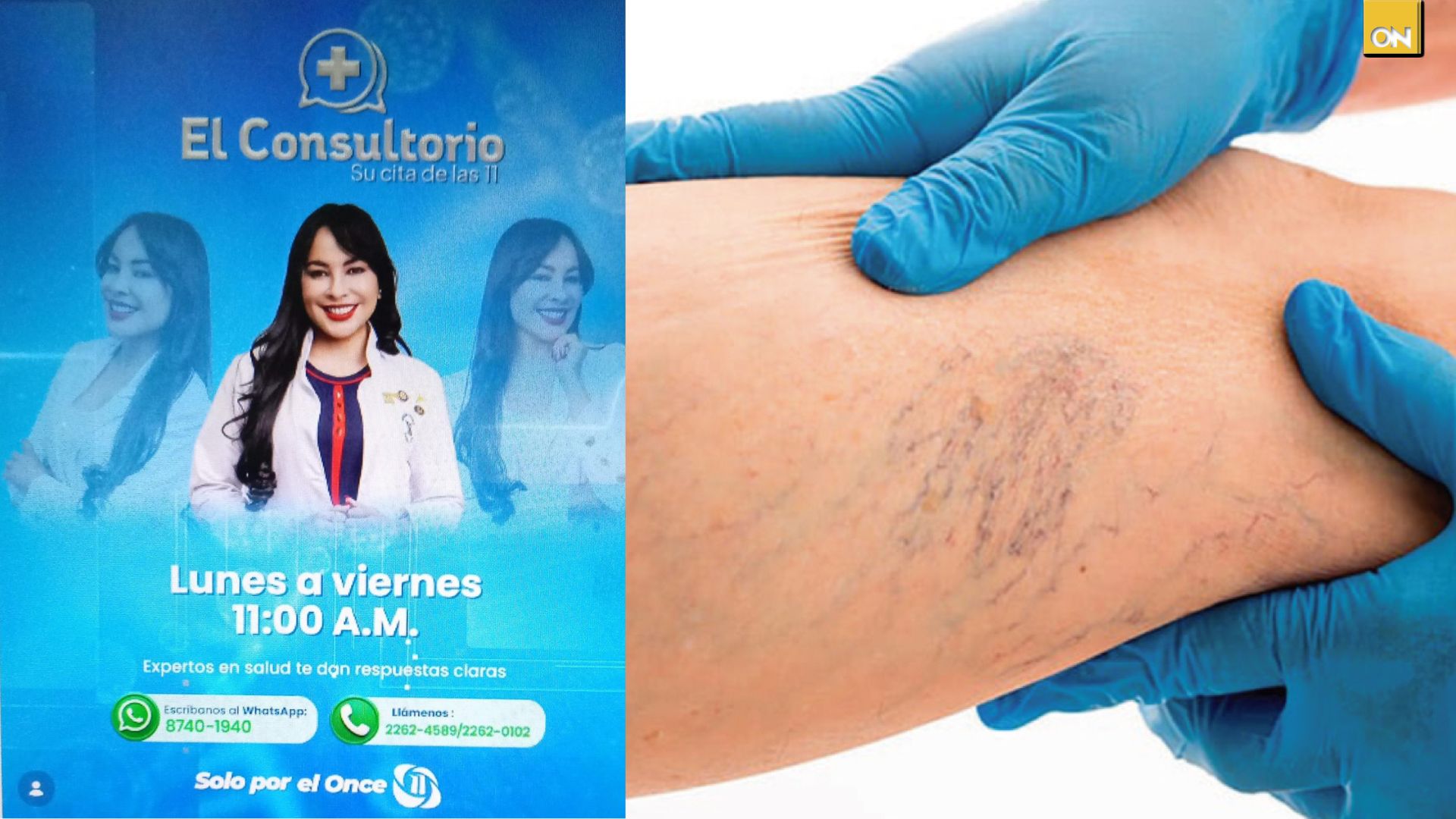 Consultorio del Once: Las piernas hablan: pesadez, dolor y calambres pueden ser señales de várices