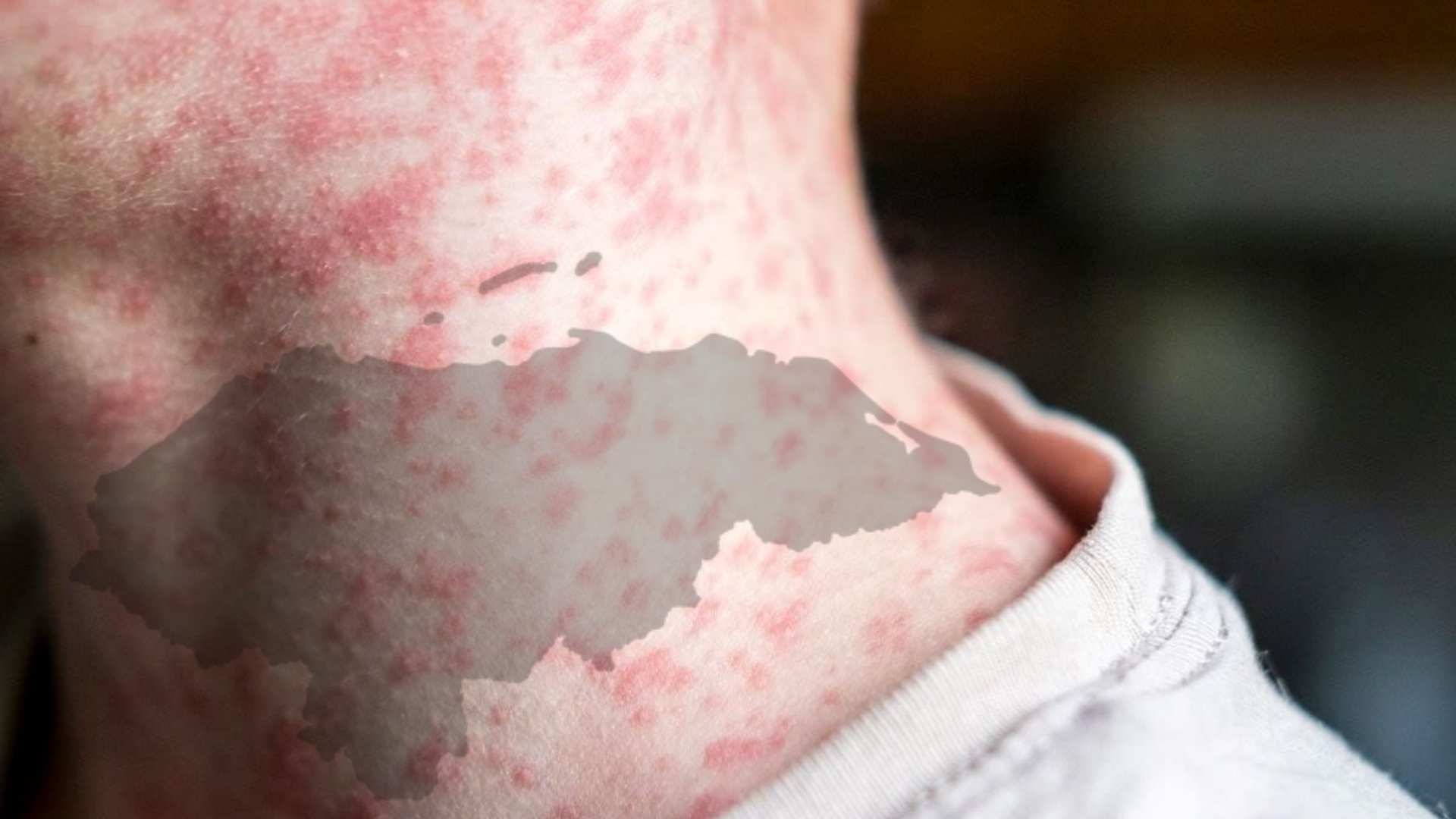 Este es el número de casos sospechoso de sarampión en Honduras; estos son los síntomas