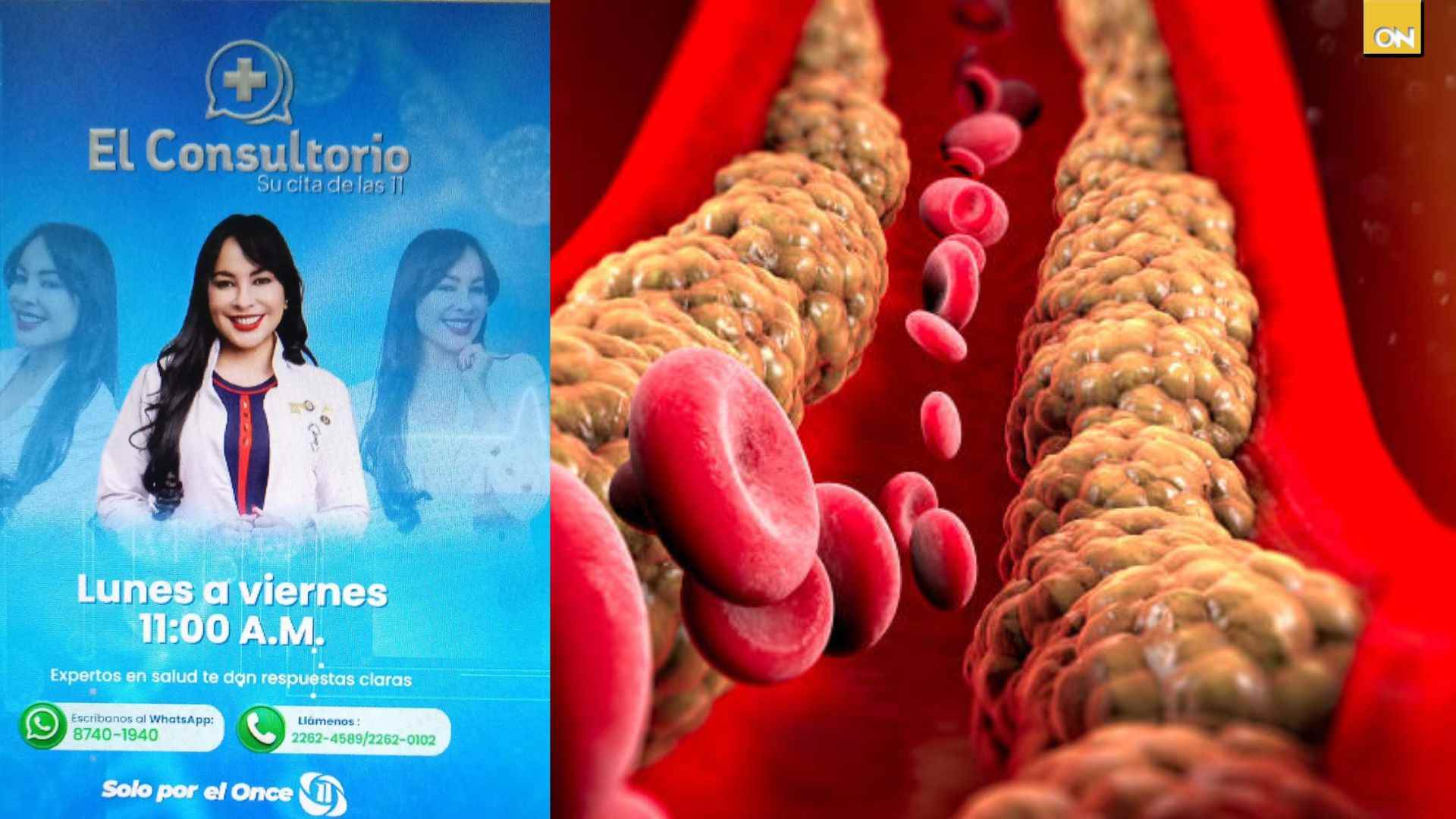 El Consultorio del Once: Descubre los lípidos en la sangre que impactan la salud cardiovascular