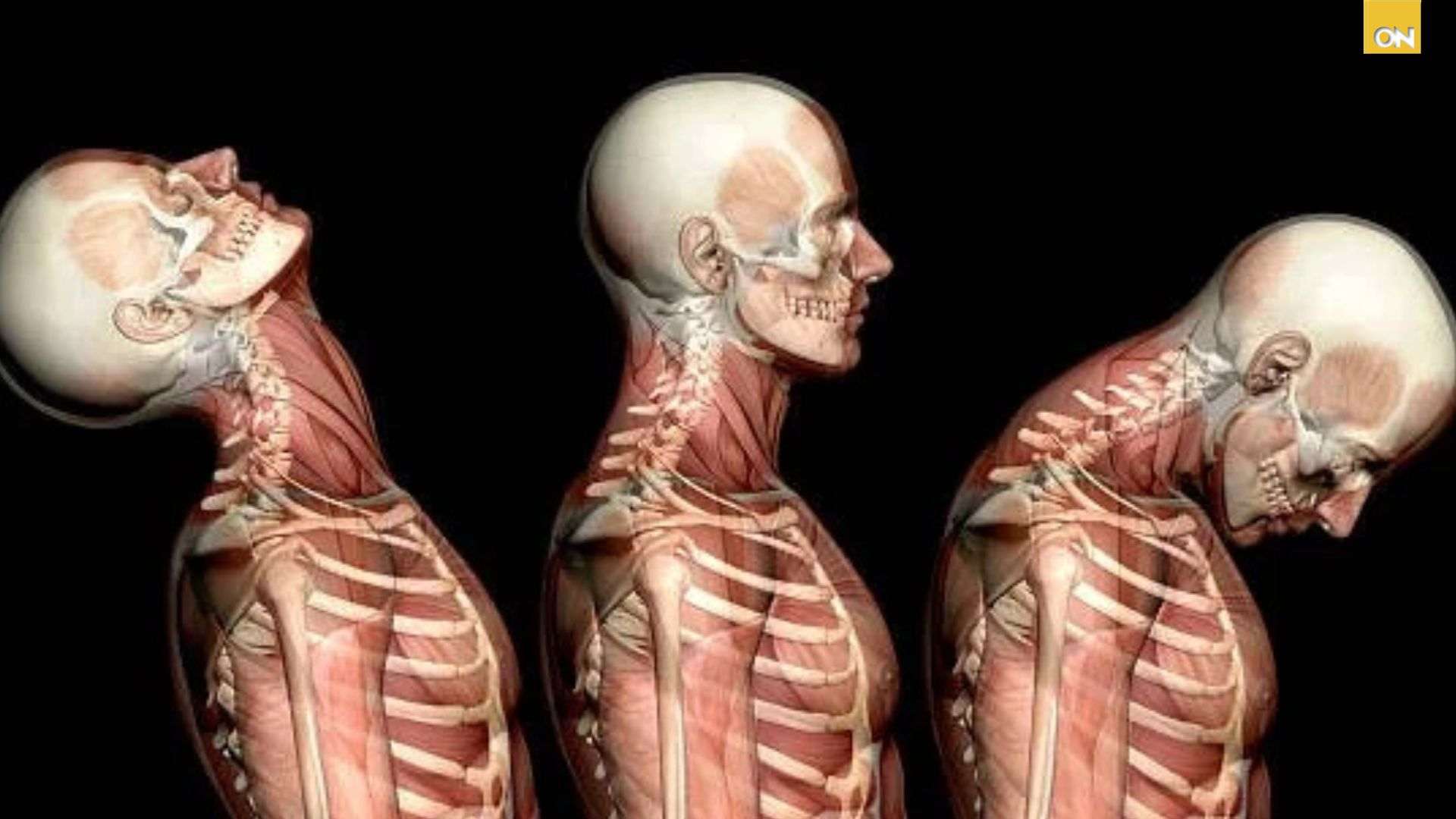 Consultorio: Rigidez y dolor intenso en el cuello, señales de alerta de la cervicalgia