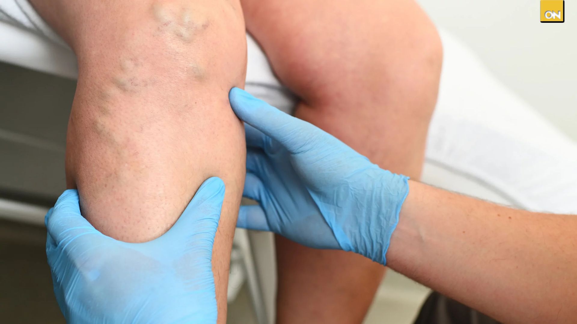 El Consultorio del Once: Pesadez y dolor en las piernas podrían alertar sobre la presencia de várices