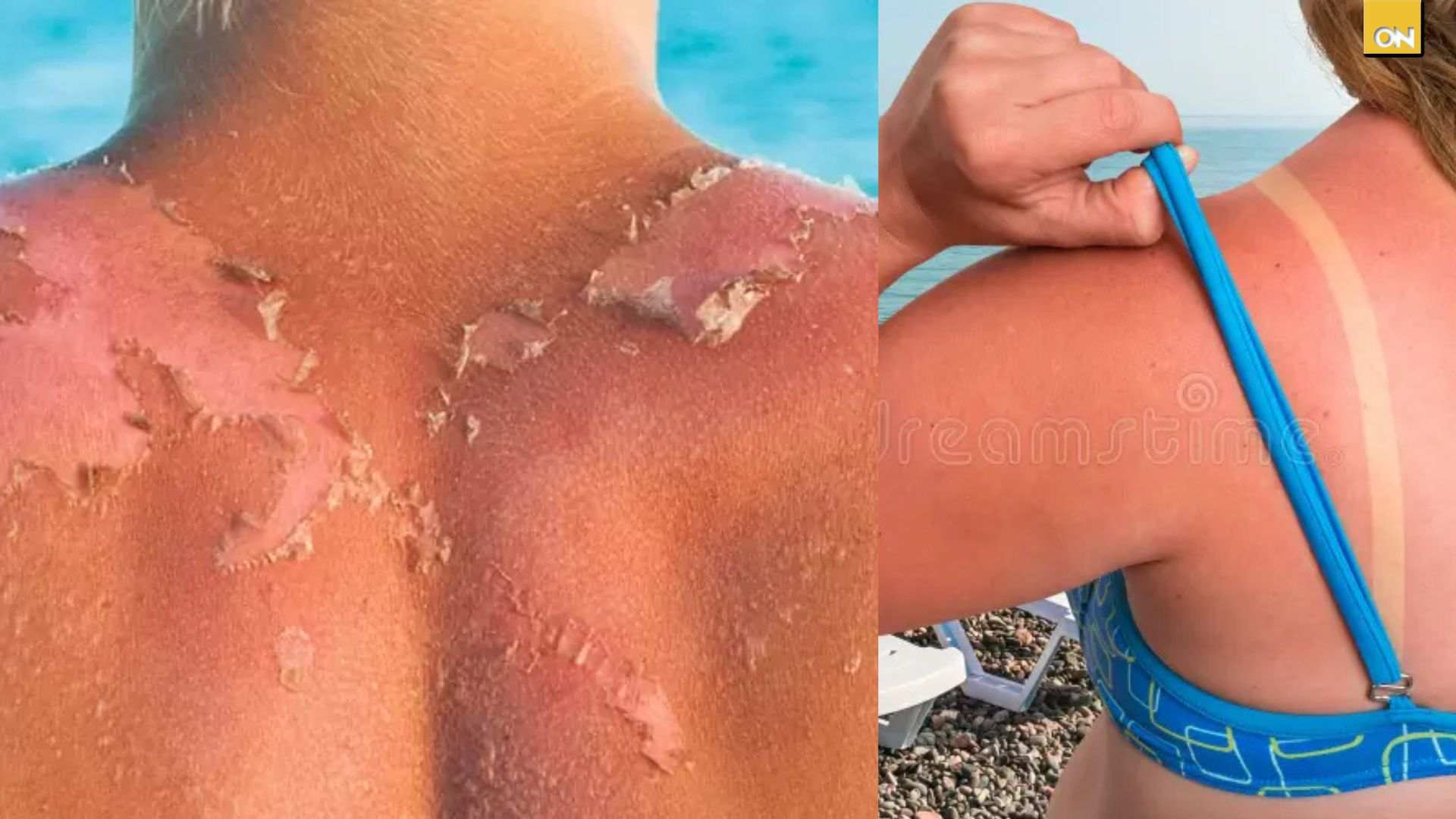 El Consultorio del Once: Especialistas alertan sobre las quemaduras solares y cómo prevenir daños en la piel