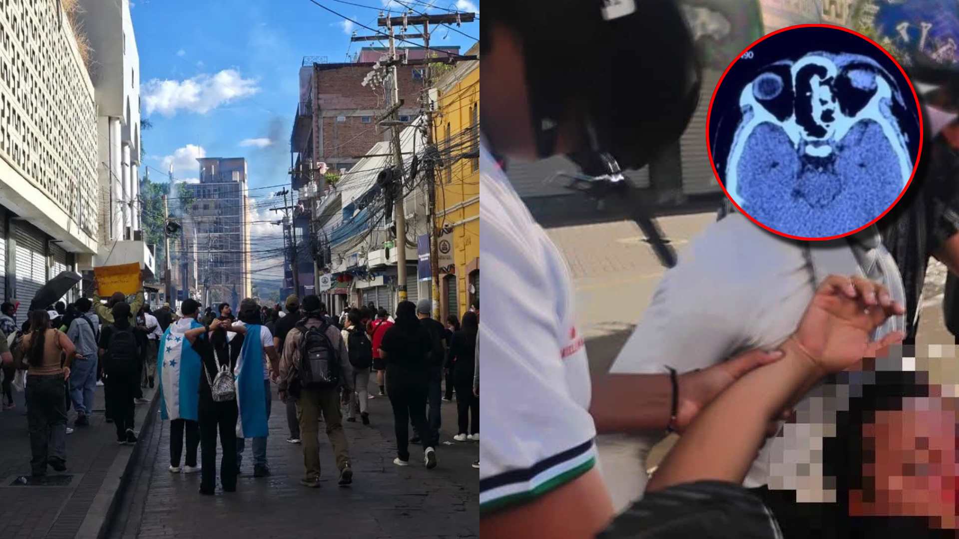 Así se encuentra estudiante herido tras protesta por UNAH