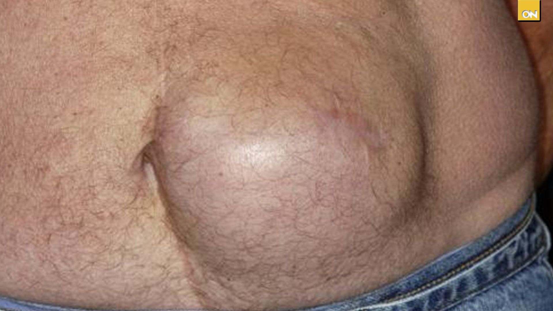 El Consultorio del Once: ¿Dolor constante? Las hernias podrían estar afectando tu estilo de vida
