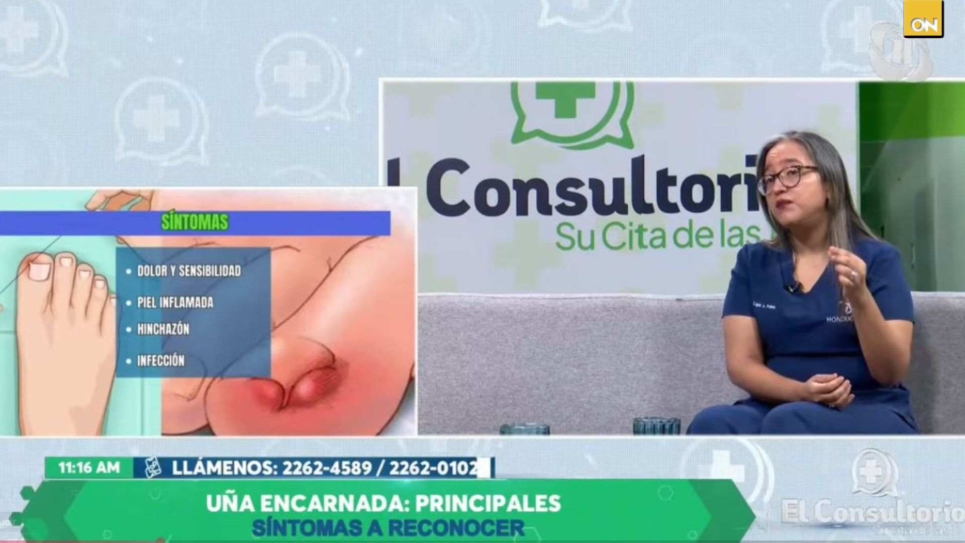 El Consultorio del Once: experta explica síntomas, causas y cuidados clave para evitar uñas encarnadas