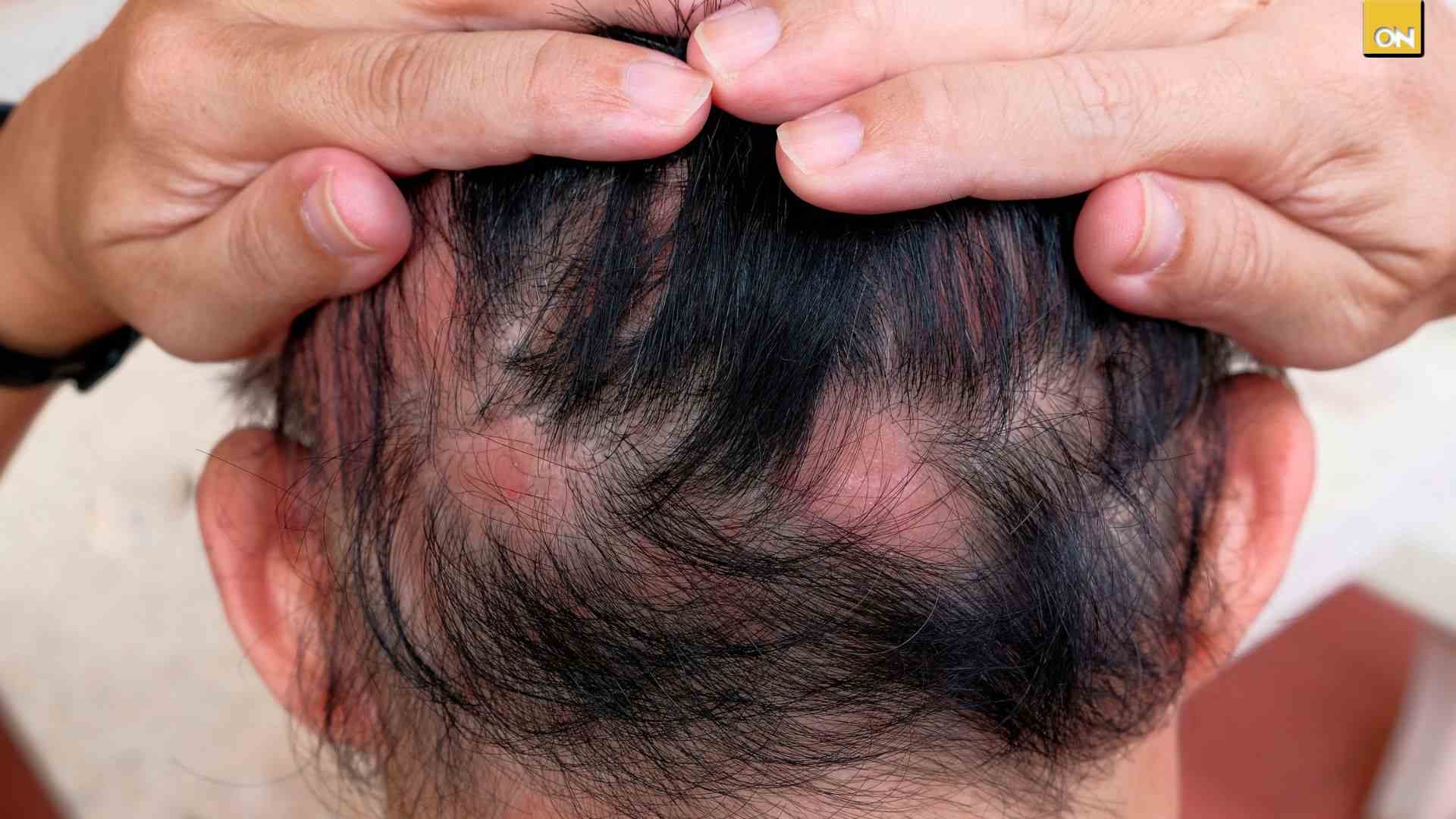 El Consultorio del Once: De mechones en la ducha a parches visibles: signos claros de alopecia