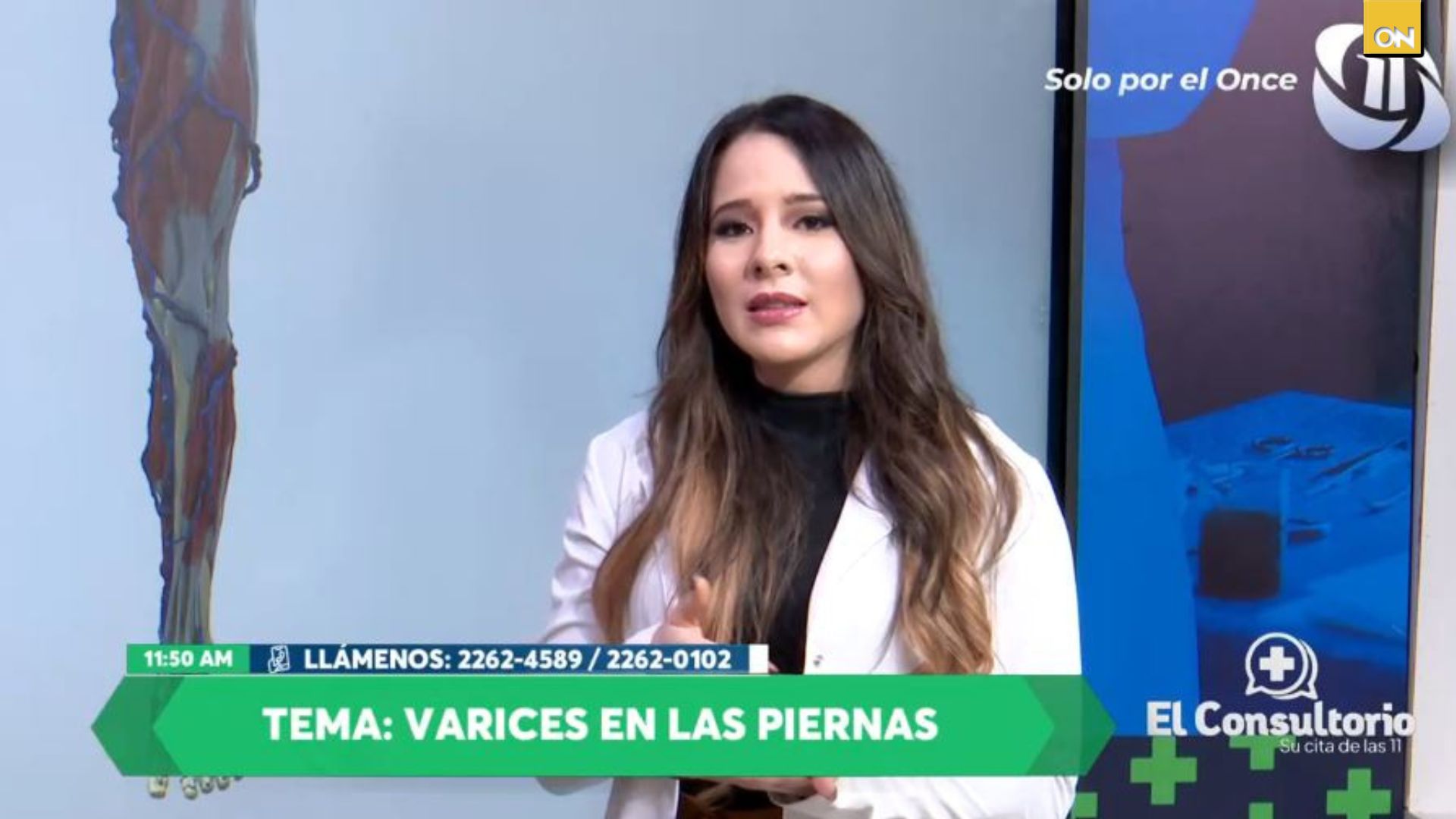 El Consultorio del Once: Especialista explica causas, síntomas y cómo prevenirlas Varices  