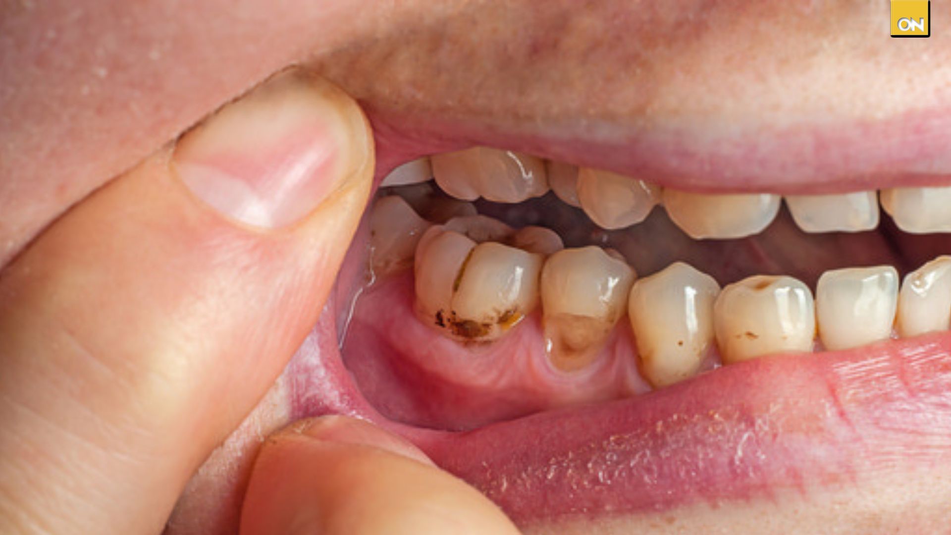 El Consultorio del Once: Sensibilidad y dolor al masticar alertan sobre posibles caries dentales