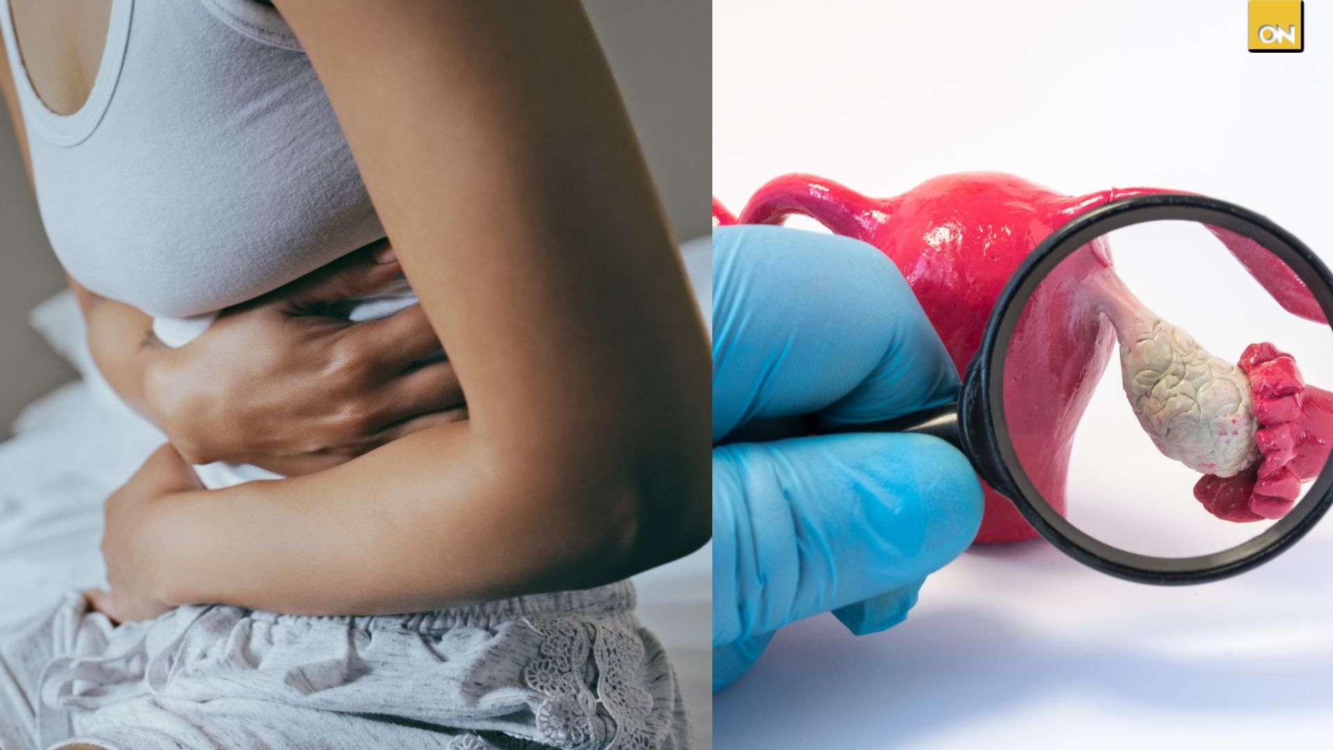 El Consultorio del Once: Irregularidades menstruales podrían alertar sobre el síndrome de ovarios poliquísticos