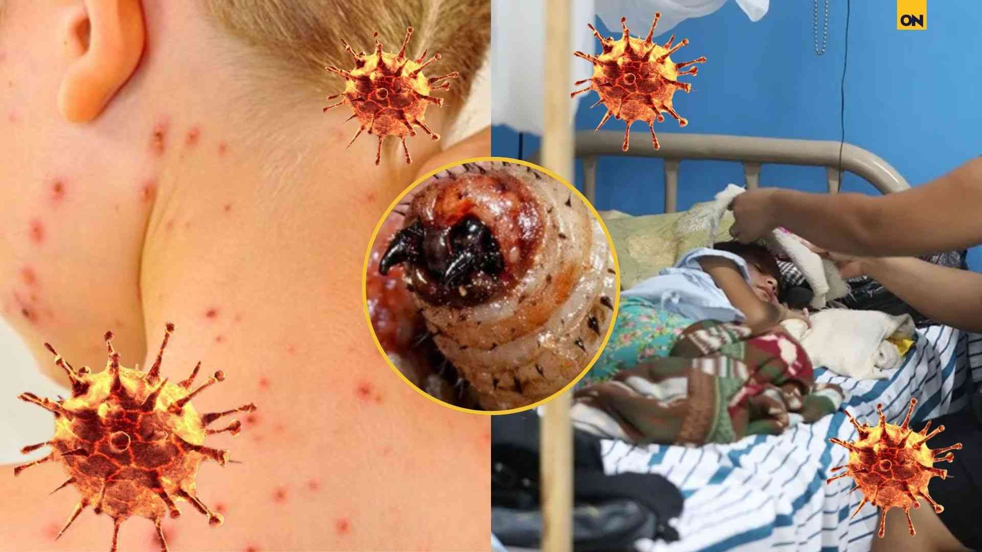 Dengue, gusano barrenador y sarampión en Honduras: epidemiólogo alerta por aumento de enfermedades