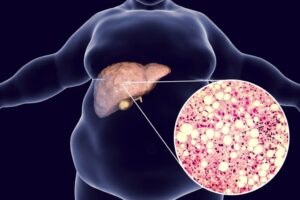 El Consultorio del Once Hígado graso, causas y riesgos para la salud