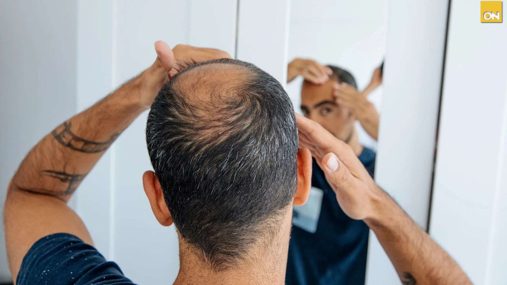 El Consultorio del Once ¿Sufres de calvicie Cuidado, podrías estar perdiendo más que tu cabello, según especialista