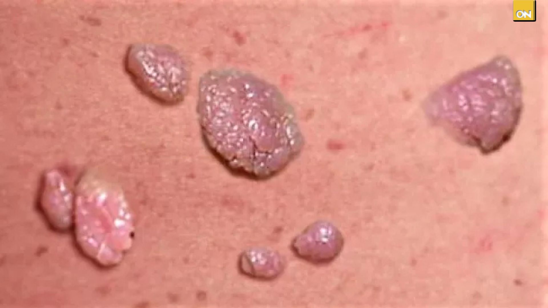 El Consultorio del Once: Virus de papiloma humano una infección silenciosa que puede manifestarse con verrugas, molestias, según especialistas