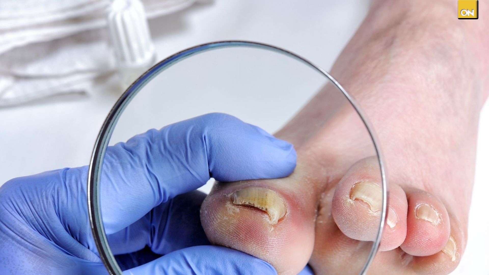 El Consultorio del Once: Uñas amarillas y quebradizas alertan sobre posible onicomicosis