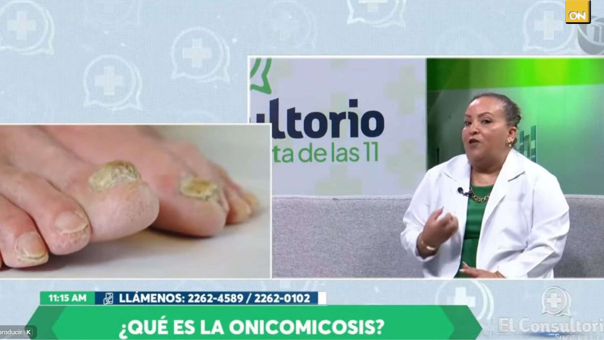 El Consultorio del Once: Especialista alerta sobre la onicomicosis y llama a la prevención en pacientes diabéticos