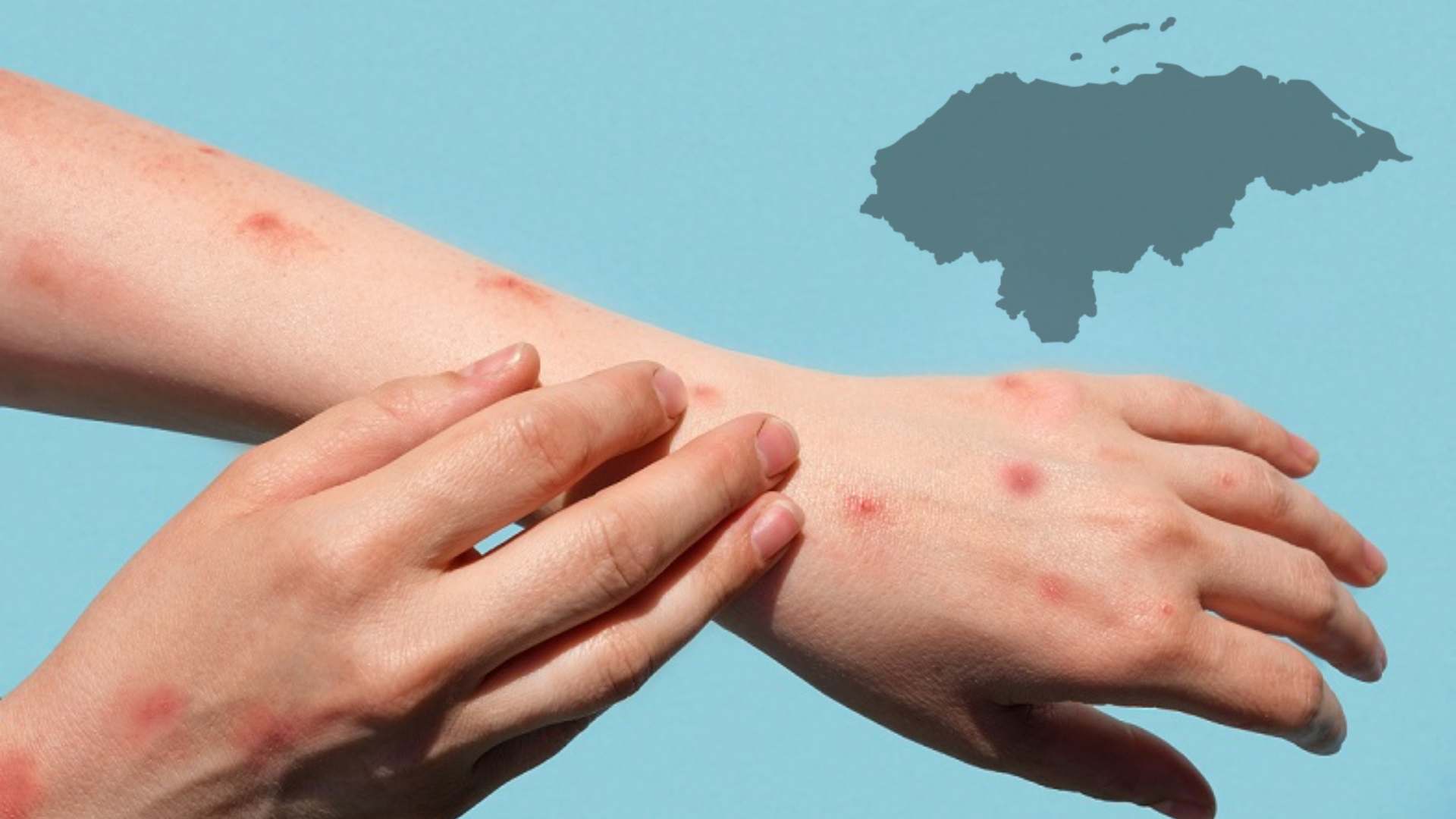 Caso de sarampión en Honduras: ¿Qué es y cómo se contagia?