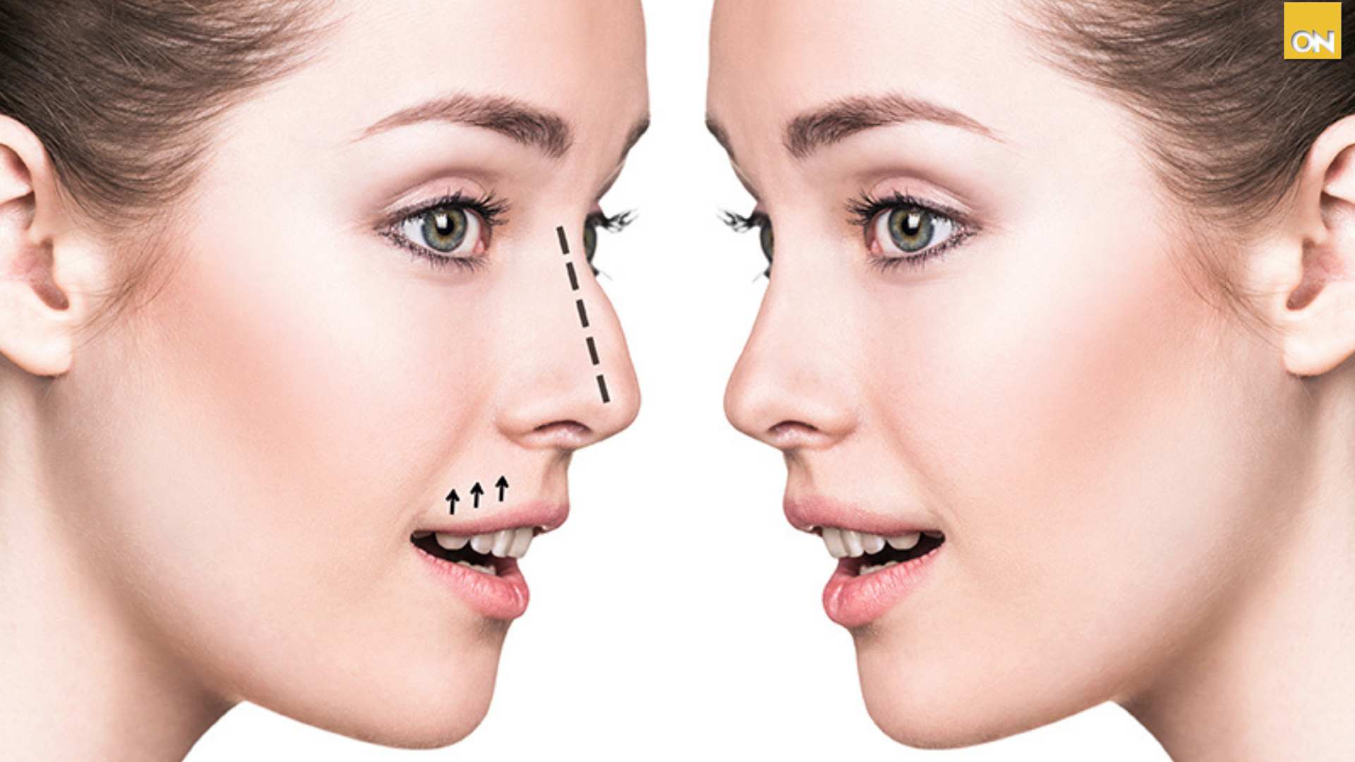 Consultorio del Once Rinoplastía, ¿función y estética van de la mano