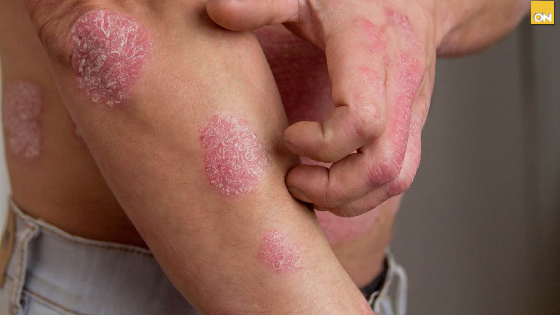 Consultorio del Once ¿Qué son los eccemas en la piel y cómo afectan la salud