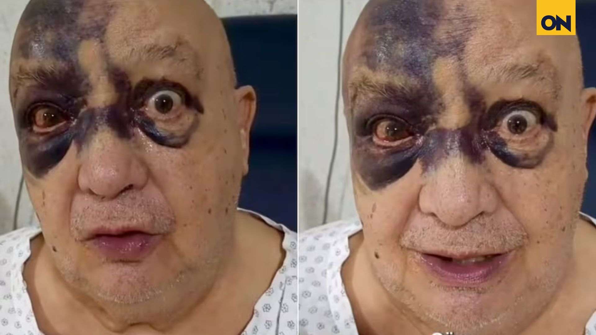 ¿Qué le pasó a Luis de Alba? El comediante aparece con hematomas en el rostro