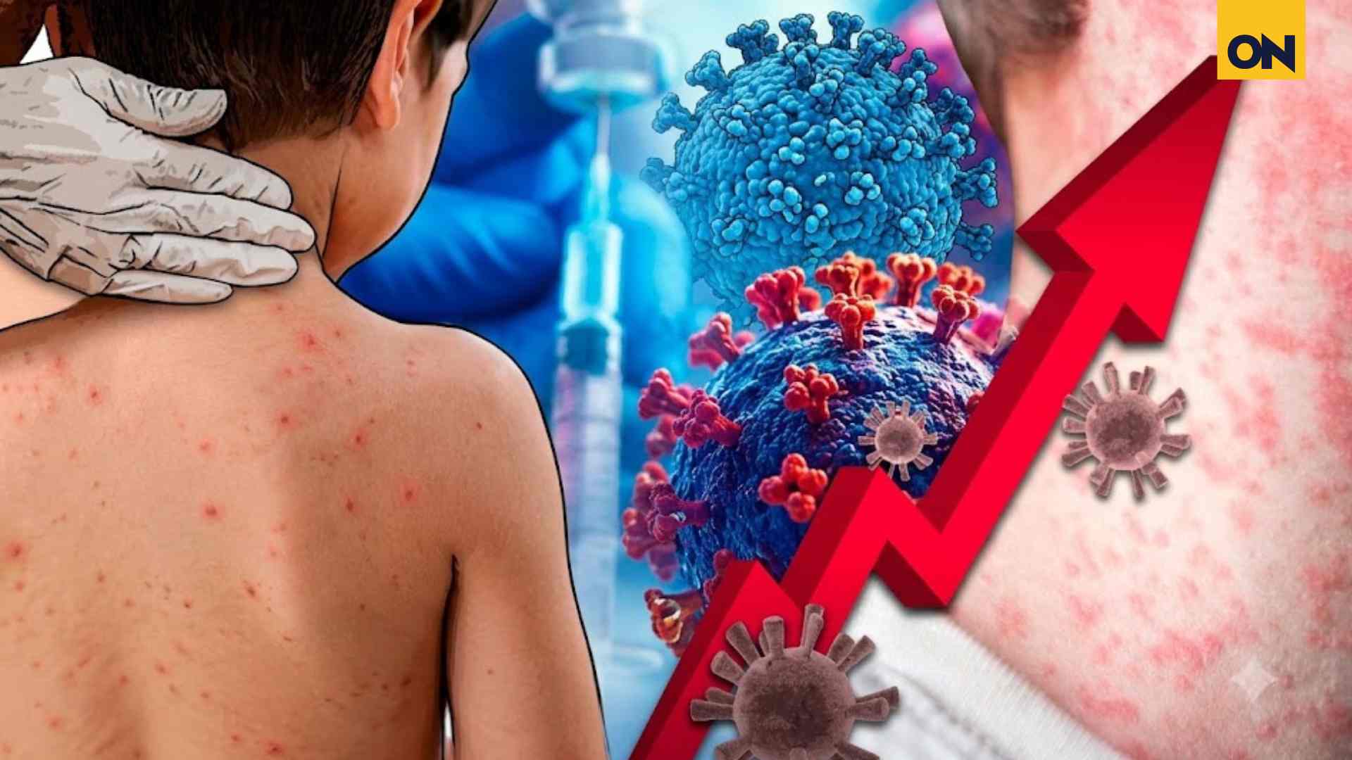 ¿Epidemia de sarampión en Honduras? Esto es lo que advierten los expertos