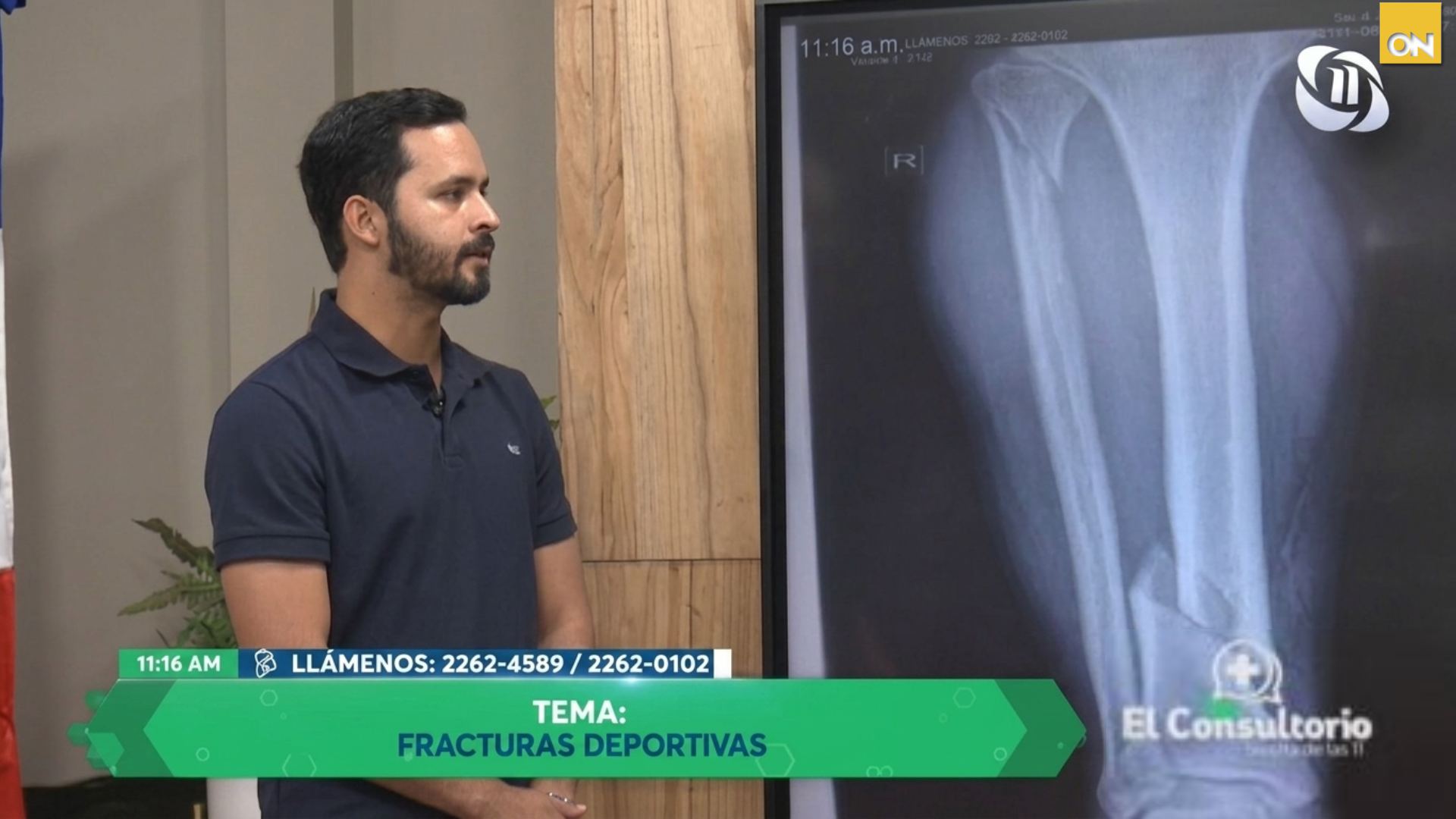 El Consultorio del Once: Fracturas deportivas y prevención ¿Cómo reconocer una lesión ósea en el deporte?