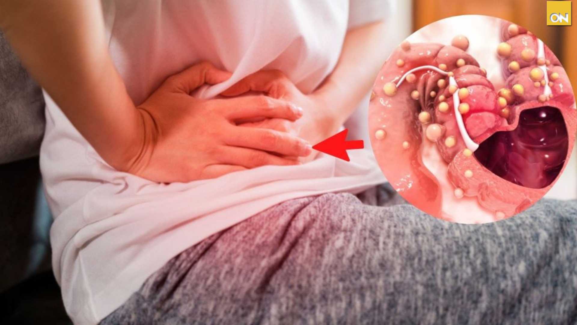 El Consultorio del Once: ¿Qué debemos saber del cáncer de colon?